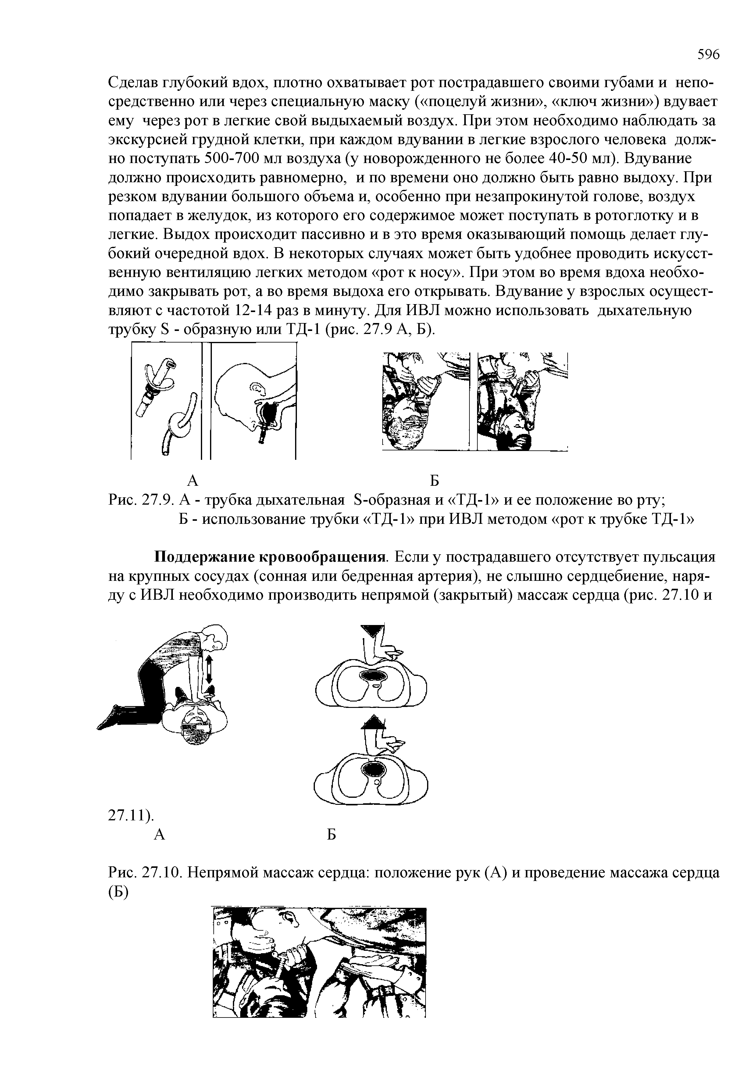 Рис. 27.10. Непрямой массаж сердца положение рук (А) и проведение массажа сердца (Б)...