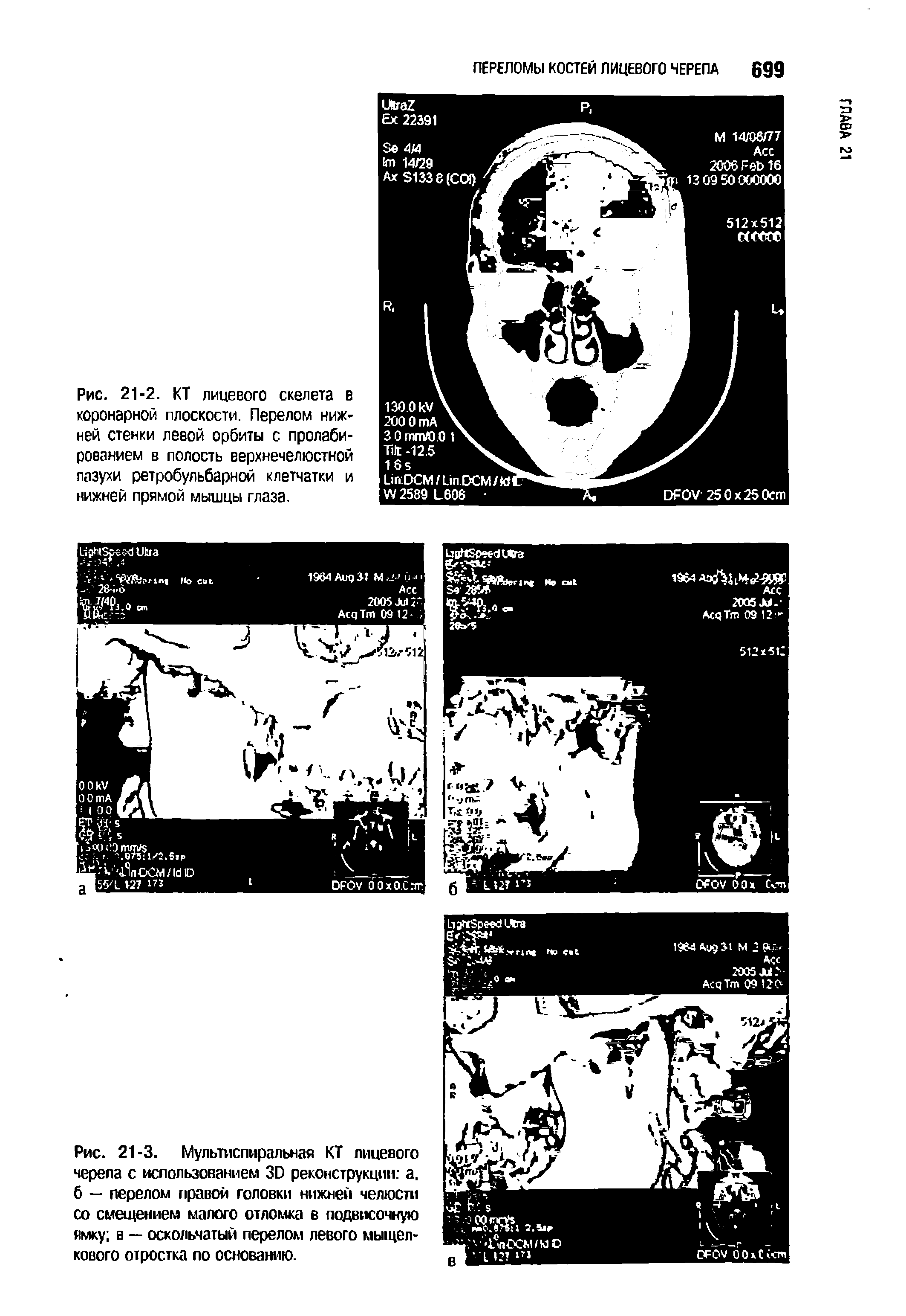 Рис. 21-3. Мультиспиральная КТ лицевого черепа с использованием 30 реконструкции а. б — перелом правой головки нижней челюсти со смещением малого отломка в подвисочную ямку в — оскольчатый перелом левого мыщелкового отростка по основанию.