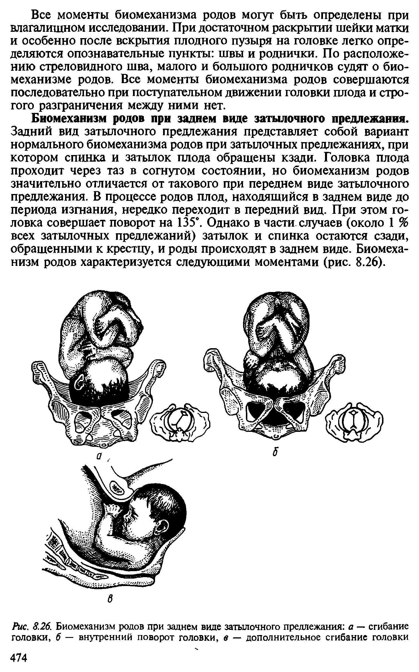 Рис. 8.26. Биомеханизм родов при заднем виде затылочного предлежания а — сгибание головки, б — внутренний поворот головки, в — дополнительное сгибание головки...