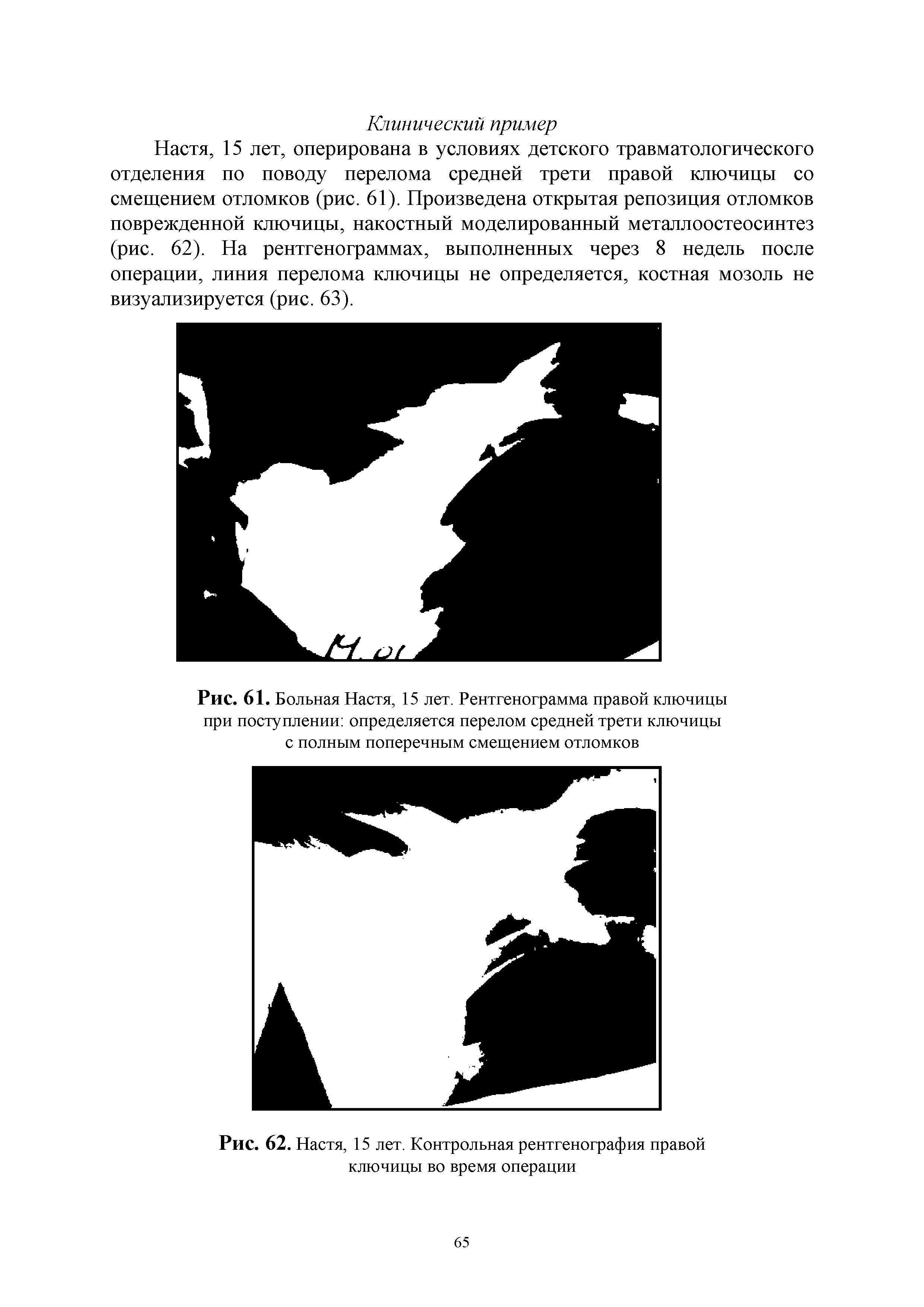 Рис. 61. Больная Настя, 15 лет. Рентгенограмма правой ключицы при поступлении определяется перелом средней трети ключицы с полным поперечным смещением отломков...