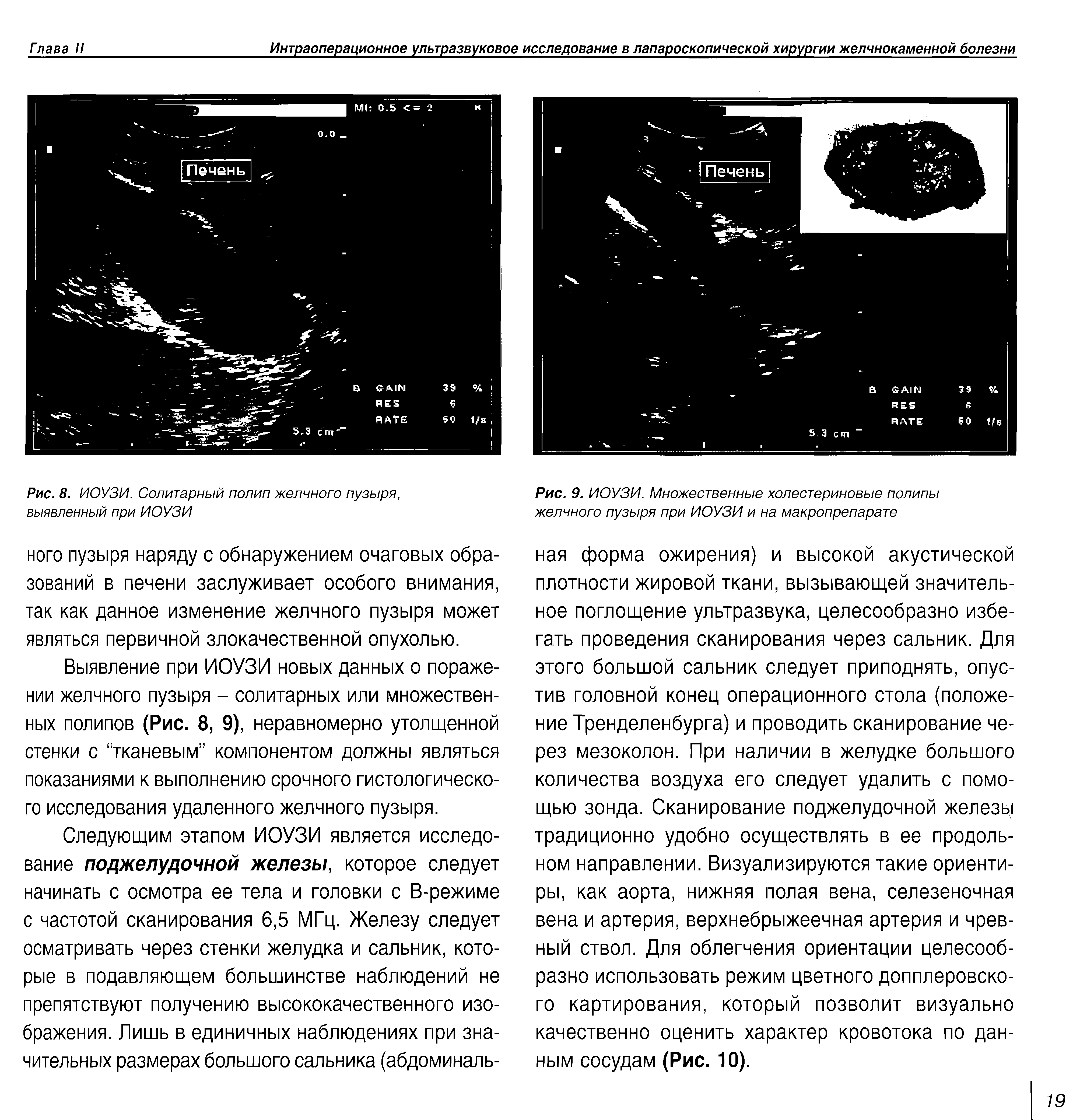 Рис. 9. ИОУЗИ. Множественные холестериновые полипы желчного пузыря при ИОУЗИ и на макропрепарате...