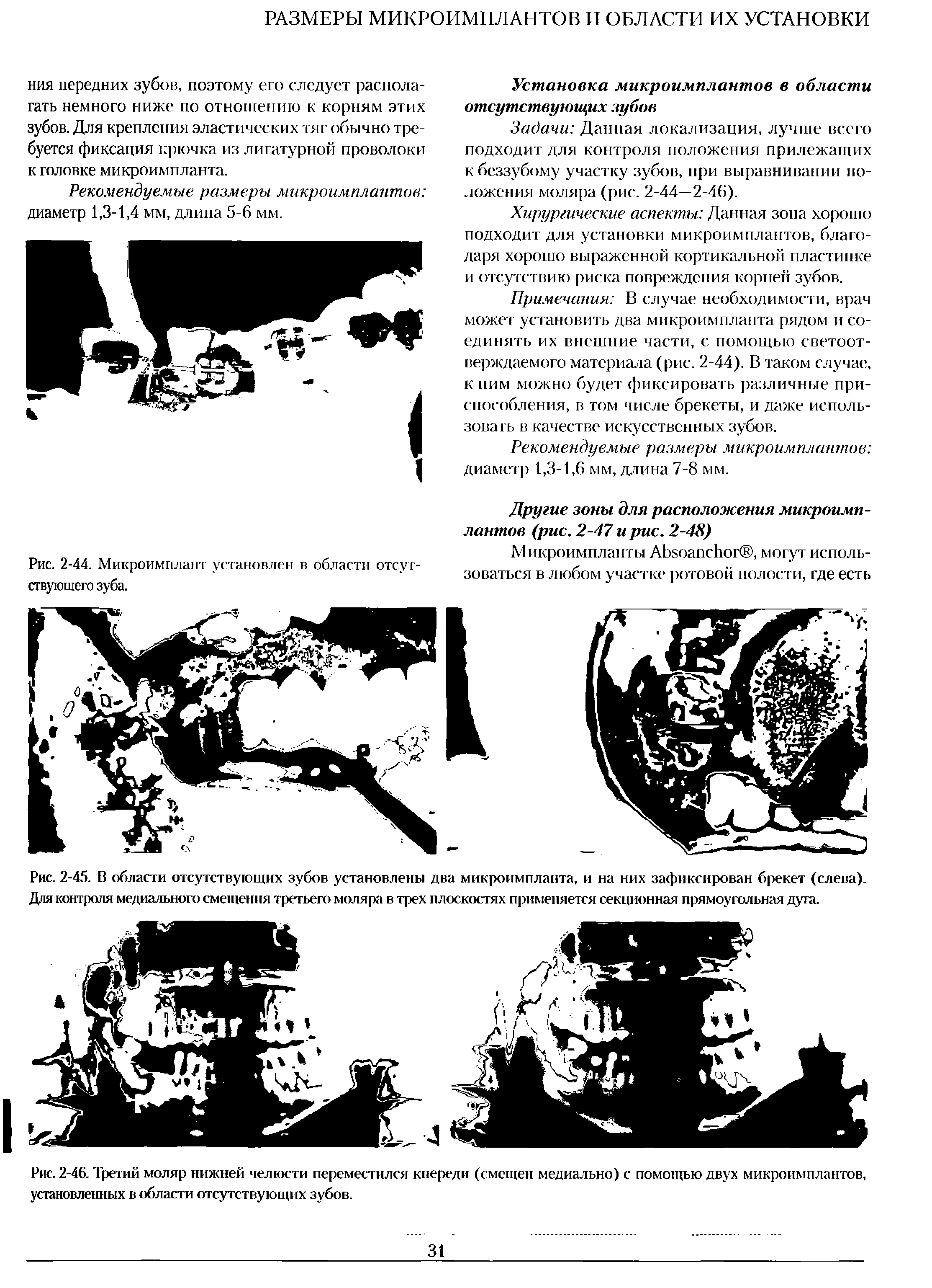 Рис. 2-46. Третий моляр нижней челюсти переместился кпереди (смещен медиально) с помощью двух микроимплантов, установленных в области отсутствующих зубов.