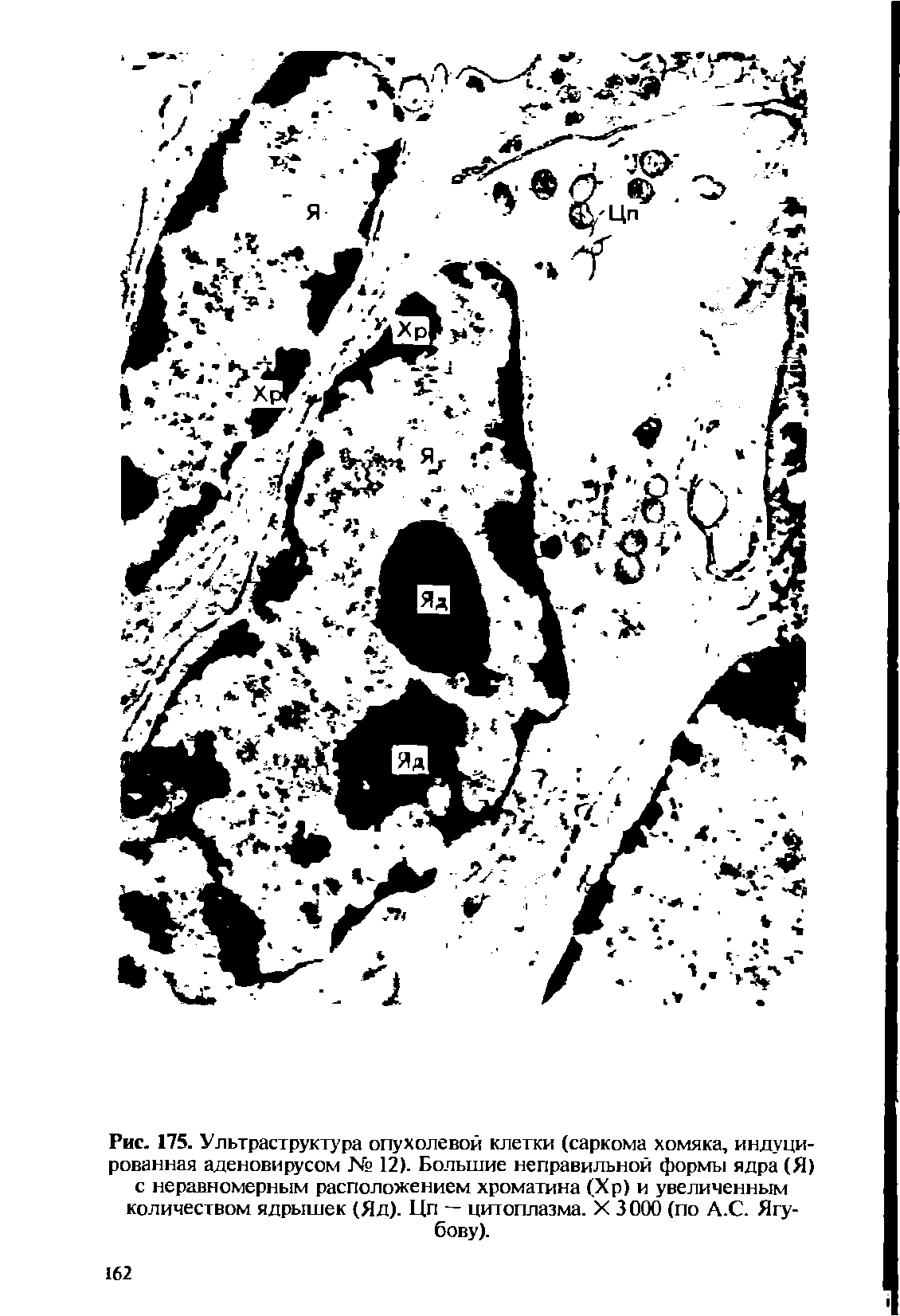 Рис. 175. Ультраструктура опухолевой клетки (саркома хомяка, индуцированная аденовирусом № 12). Большие неправильной формы ядра (Я) с неравномерным расположением хроматина (Хр) и увеличенным количеством ядрышек (Яд). Цп — цитоплазма. X 3000 (по А.С. Ягубову).