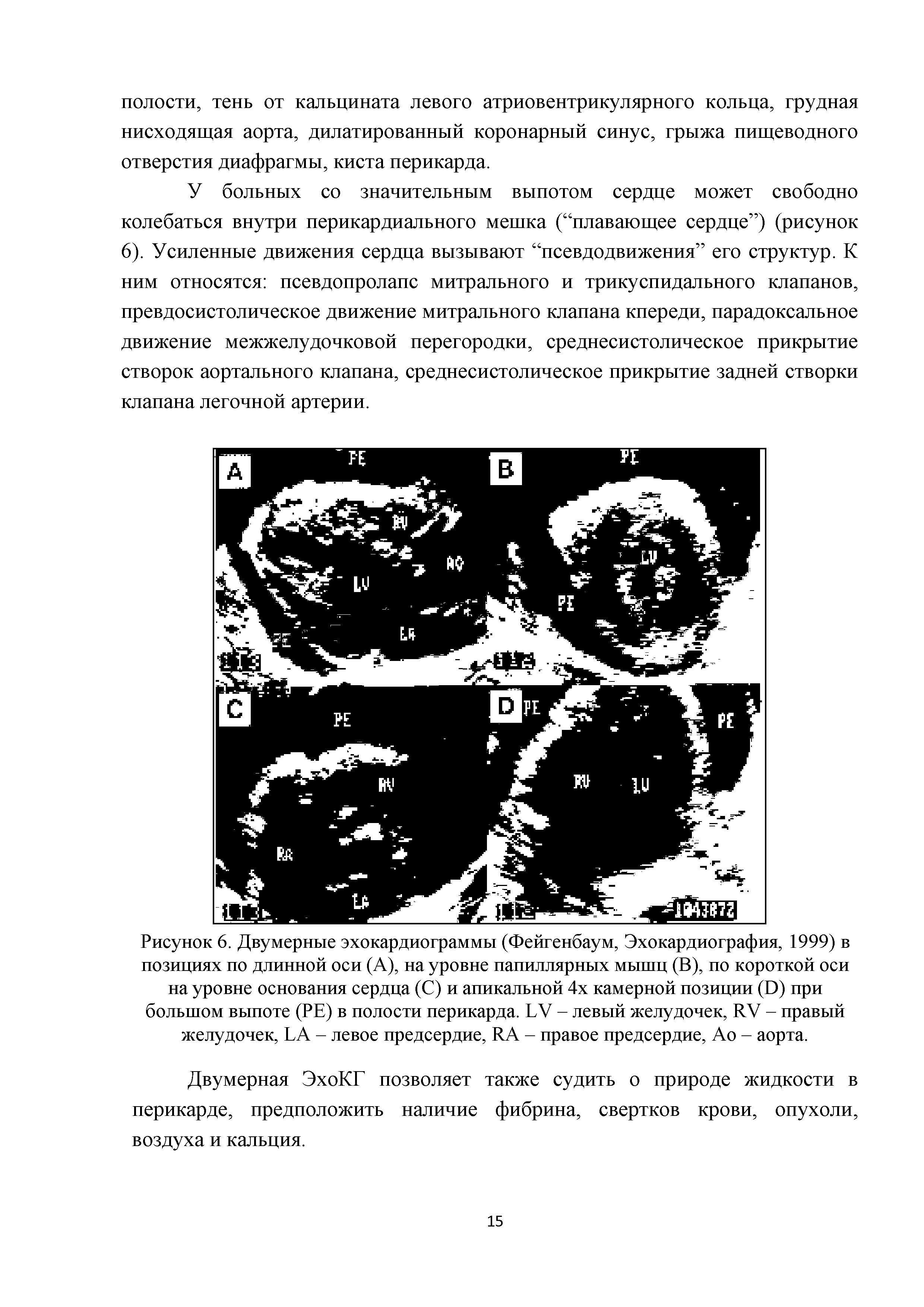 Рисунок 6. Двумерные эхокардиограммы (Фейгенбаум, Эхокардиография, 1999) в позициях по длинной оси (А), на уровне папиллярных мышц (В), по короткой оси на уровне основания сердца (С) и апикальной 4х камерной позиции (Э) при большом выпоте (РЕ) в полости перикарда. ЬУ - левый желудочек, ЯУ - правый желудочек, ЬА - левое предсердие, ЯА - правое предсердие, Ао - аорта.