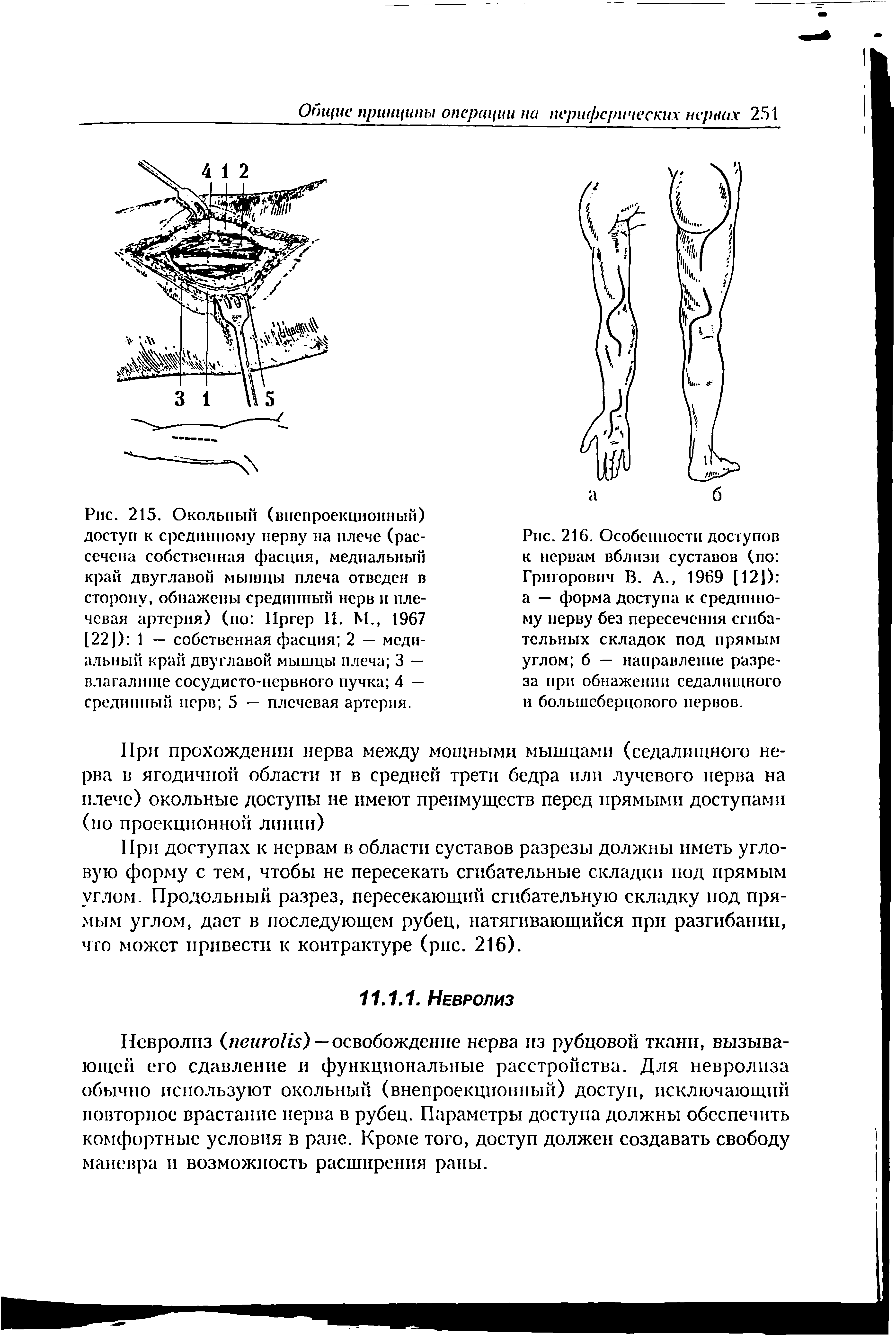 Рис. 216. Особенности доступов к нервам вблизи суставов (по Григорович В. А., 1969 [12]) а — форма доступа к срединному нерву без пересечения сгибательных складок под прямым углом б — направление разреза при обнажении седалищного и большеберцового нервов.