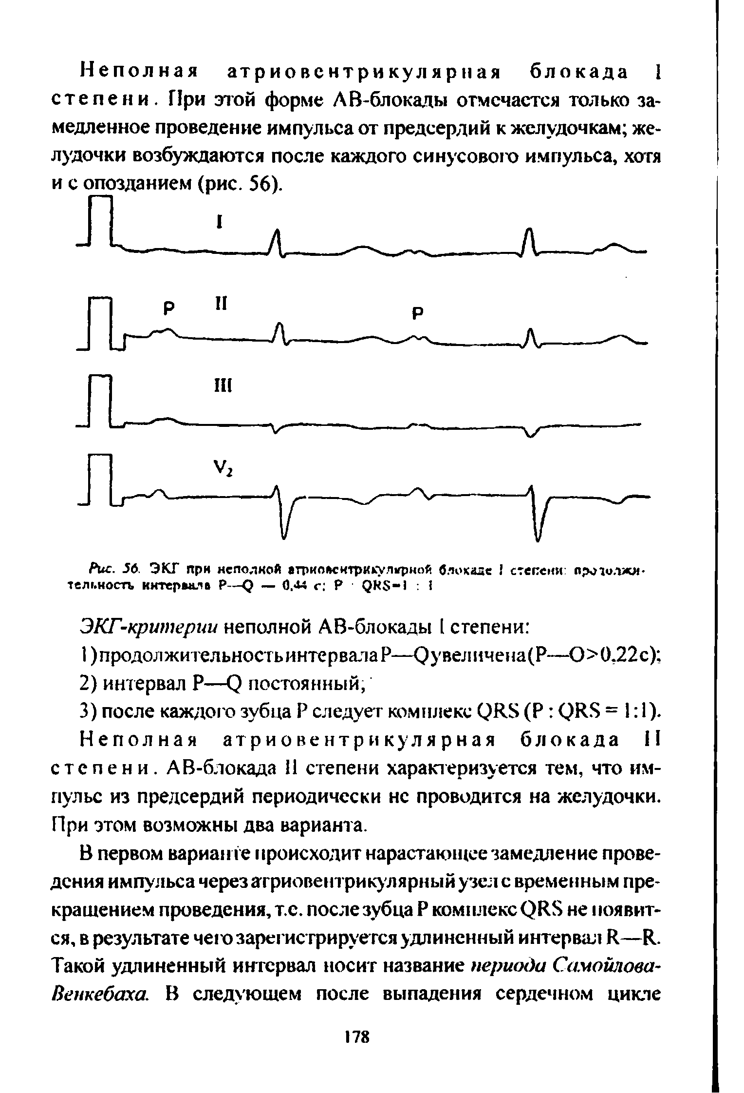 Рис. 56. ЭКГ при неполной агриойситрик у.П1грной блокаде степени ярчиилжи тельностъ интервала P—Q — 0.44 г P QRS- ...