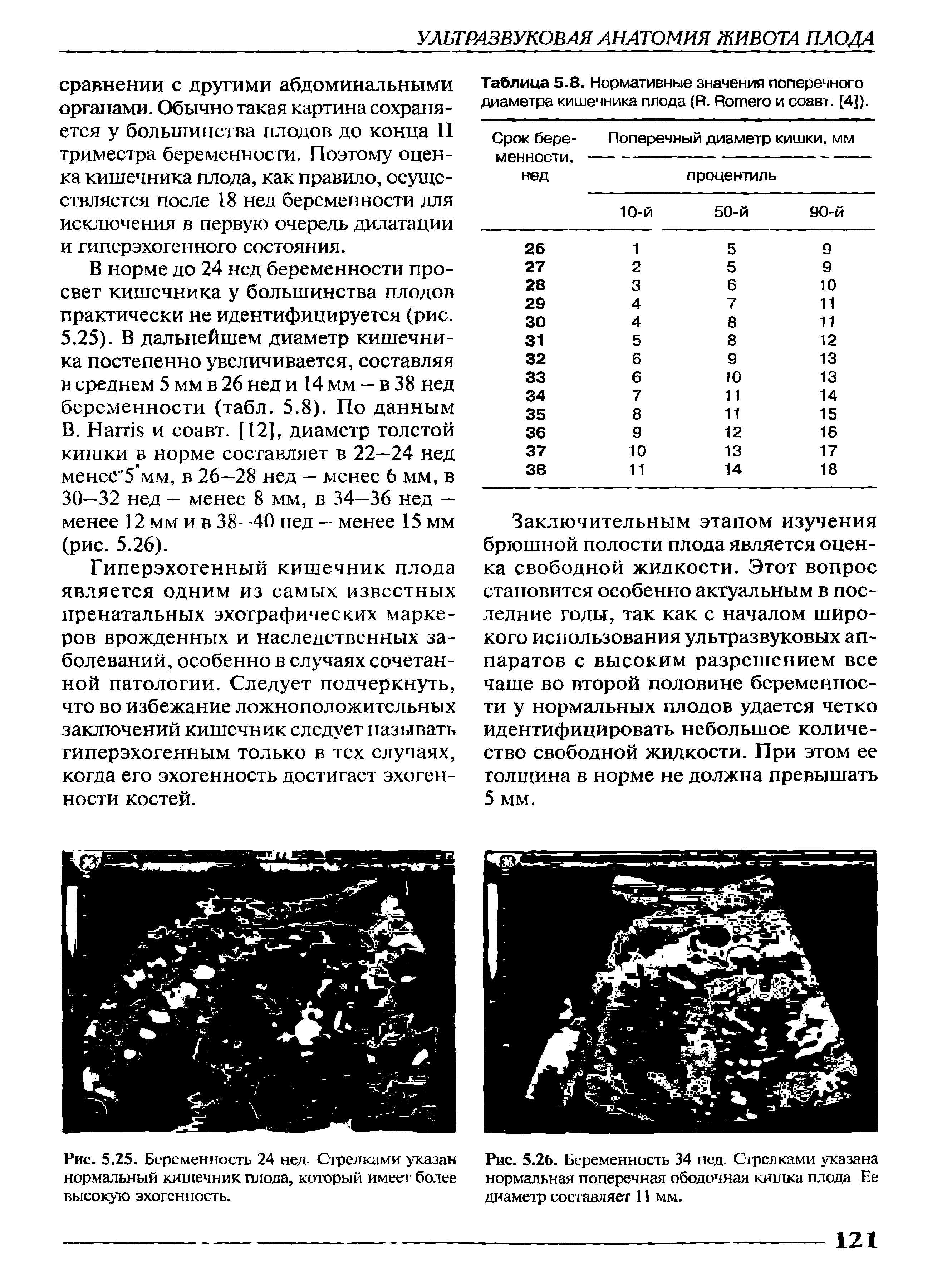 Рис. 5.25. Беременность 24 нед Стрелками указан нормальный кишечник плода, который имеет более высокую эхогенность.