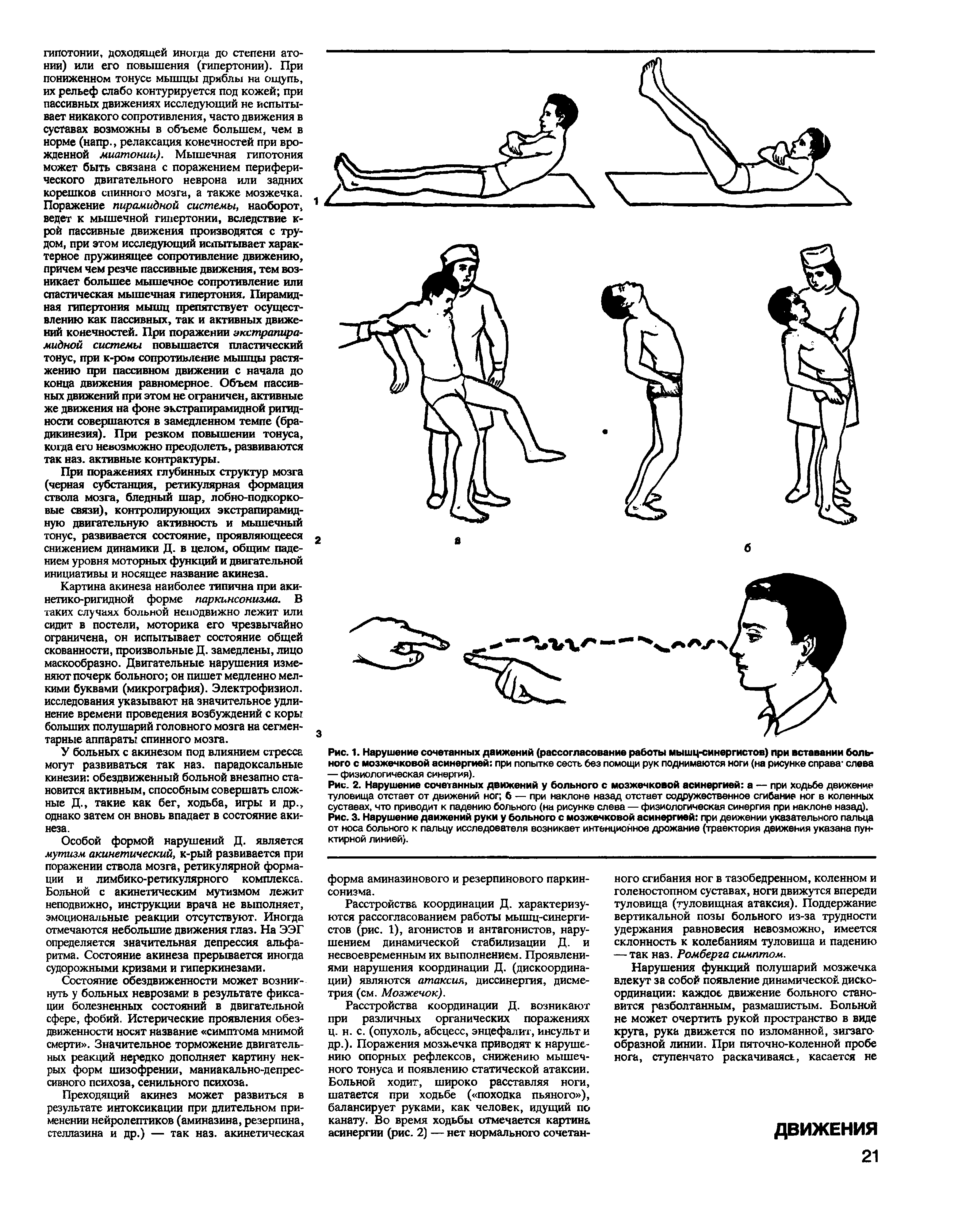 Рис. 1. Нарушение сочетанных движений (рассогласование работы мышц-синергистов) при вставании больного с мозжечковой асинергией при попытке сесть без помощи рук поднимаются ноги (на рисунке справа слева — физиологическая синергия).