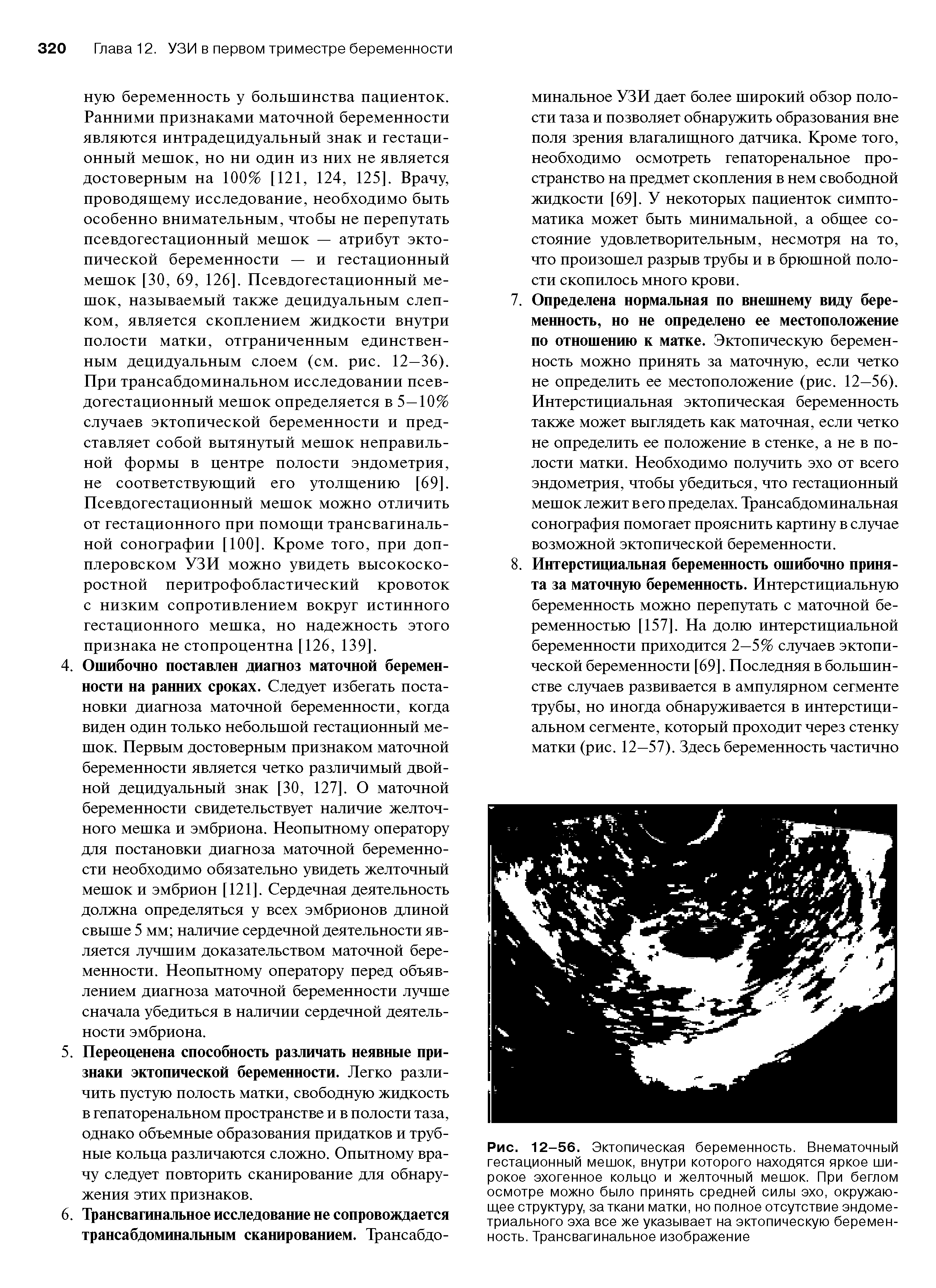 Рис. 12-56. Эктопическая беременность. Внематочный гестационный мешок, внутри которого находятся яркое широкое эхогенное кольцо и желточный мешок. При беглом осмотре можно было принять средней силы эхо, окружающее структуру, за ткани матки, но полное отсутствие эндометриального эха все же указывает на эктопическую беременность. Трансвагинальное изображение...