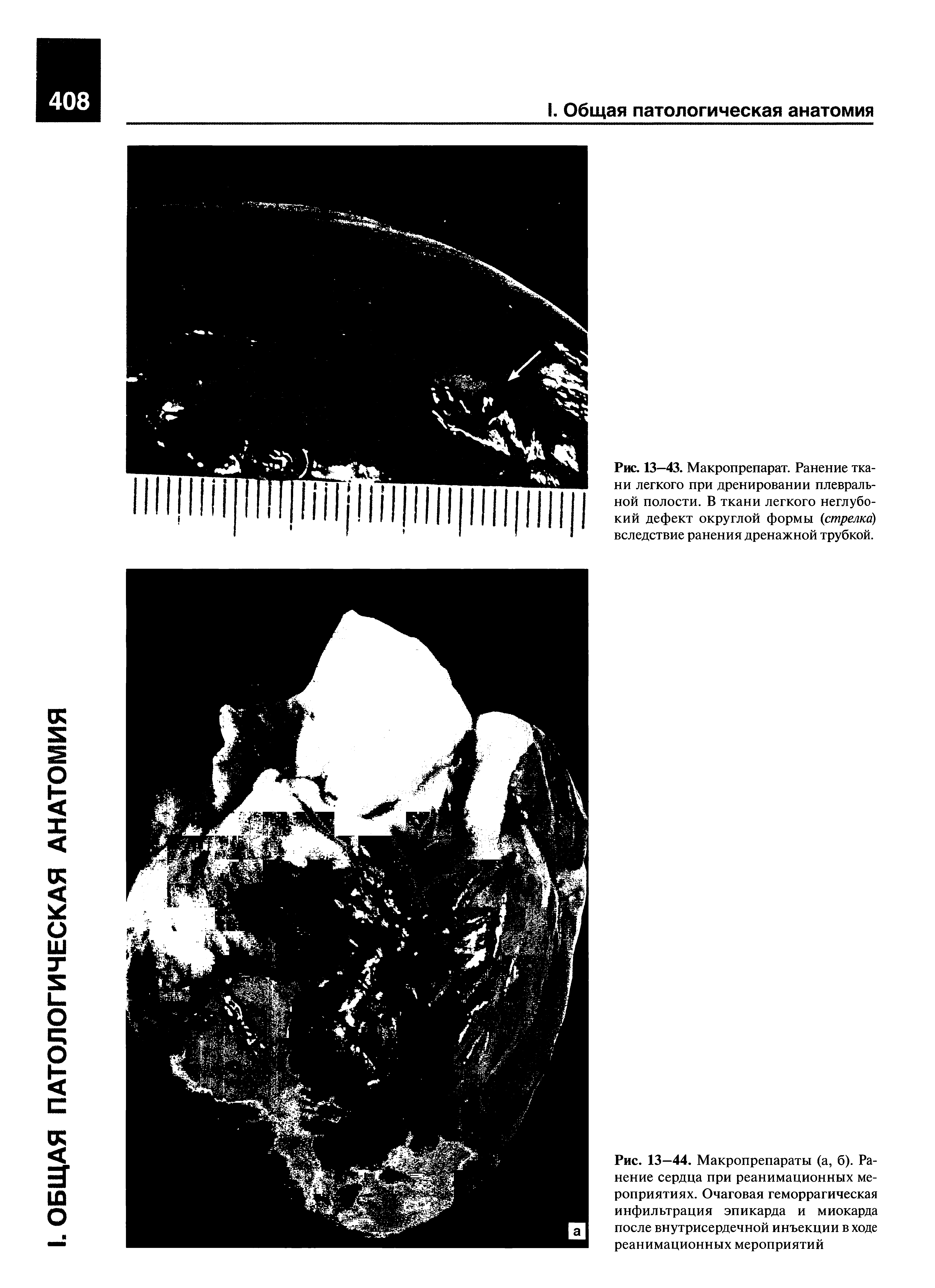 Рис. 13—44. Макропрепараты (а, б). Ранение сердца при реанимационных мероприятиях. Очаговая геморрагическая инфильтрация эпикарда и миокарда после внутрисердечной инъекции в ходе реанимационных мероприятий...