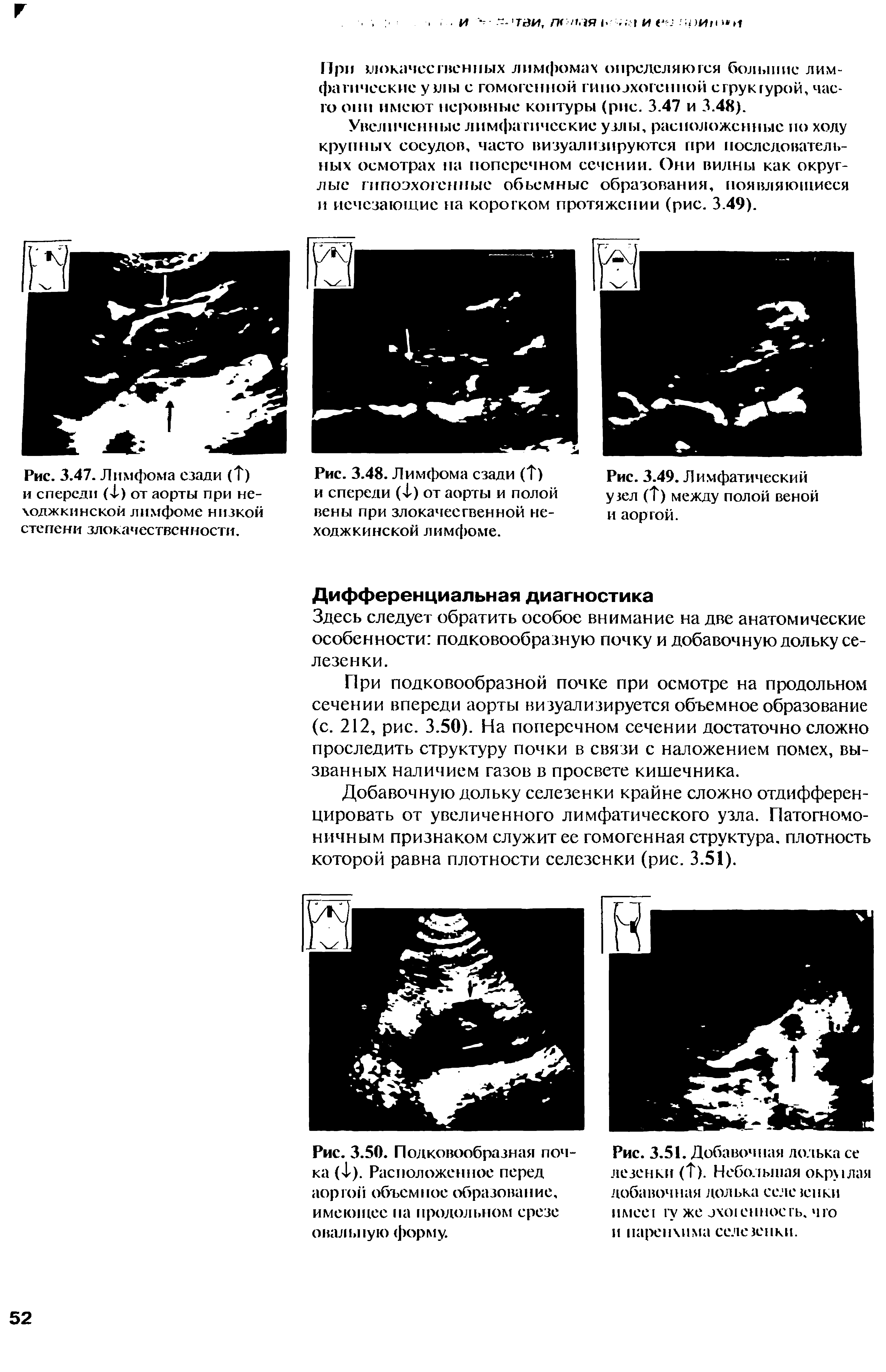 Рис. 3.47. Лимфома сзади ( ) и спереди ( ) от аорты при не-ходжкинской лимфоме низкой степени злокачественности.