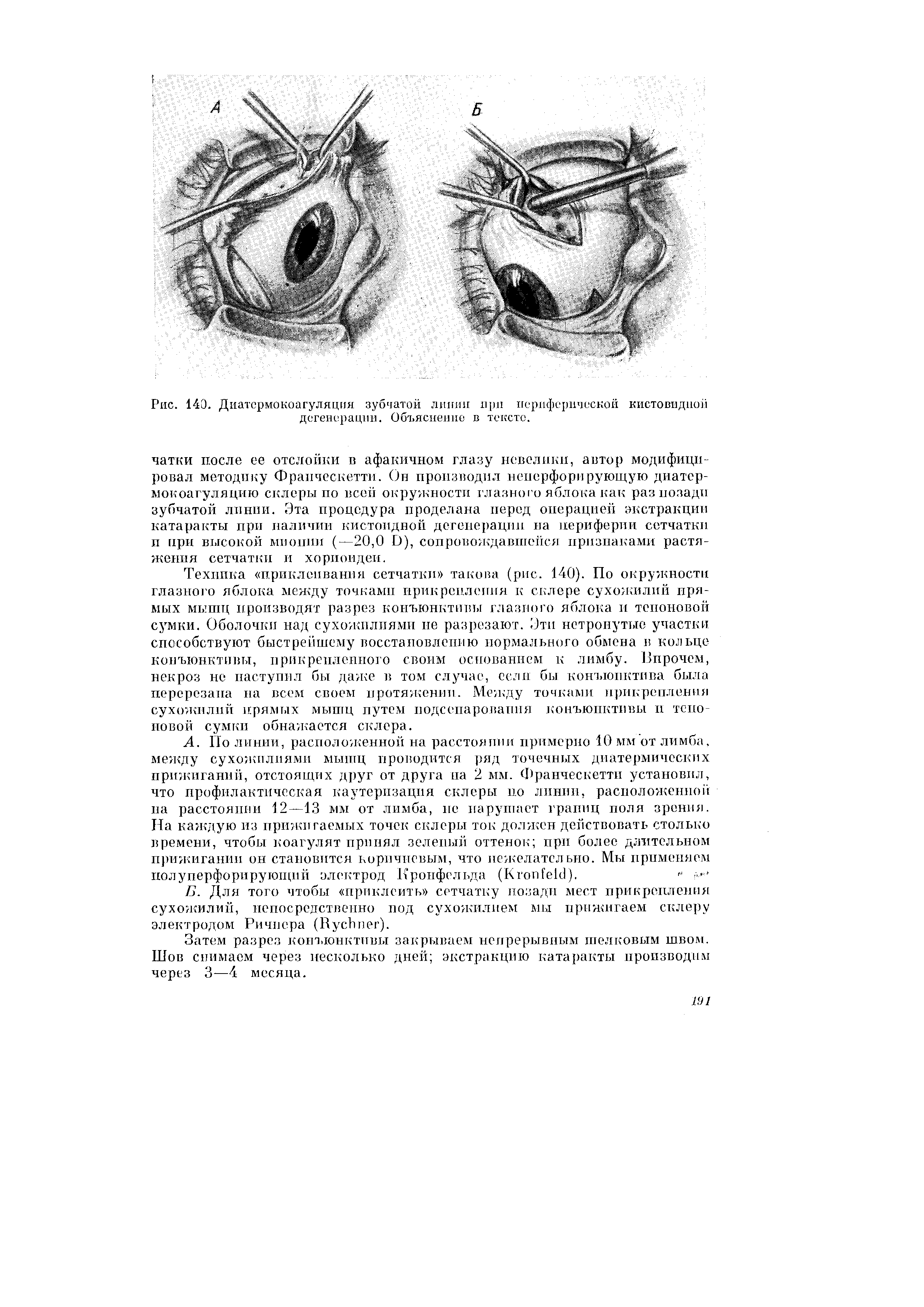 Рис. 140. Диатсрмокоагуляция зубчатой линии при периферической кистевидной дегенерации. Объяснение в тексте.