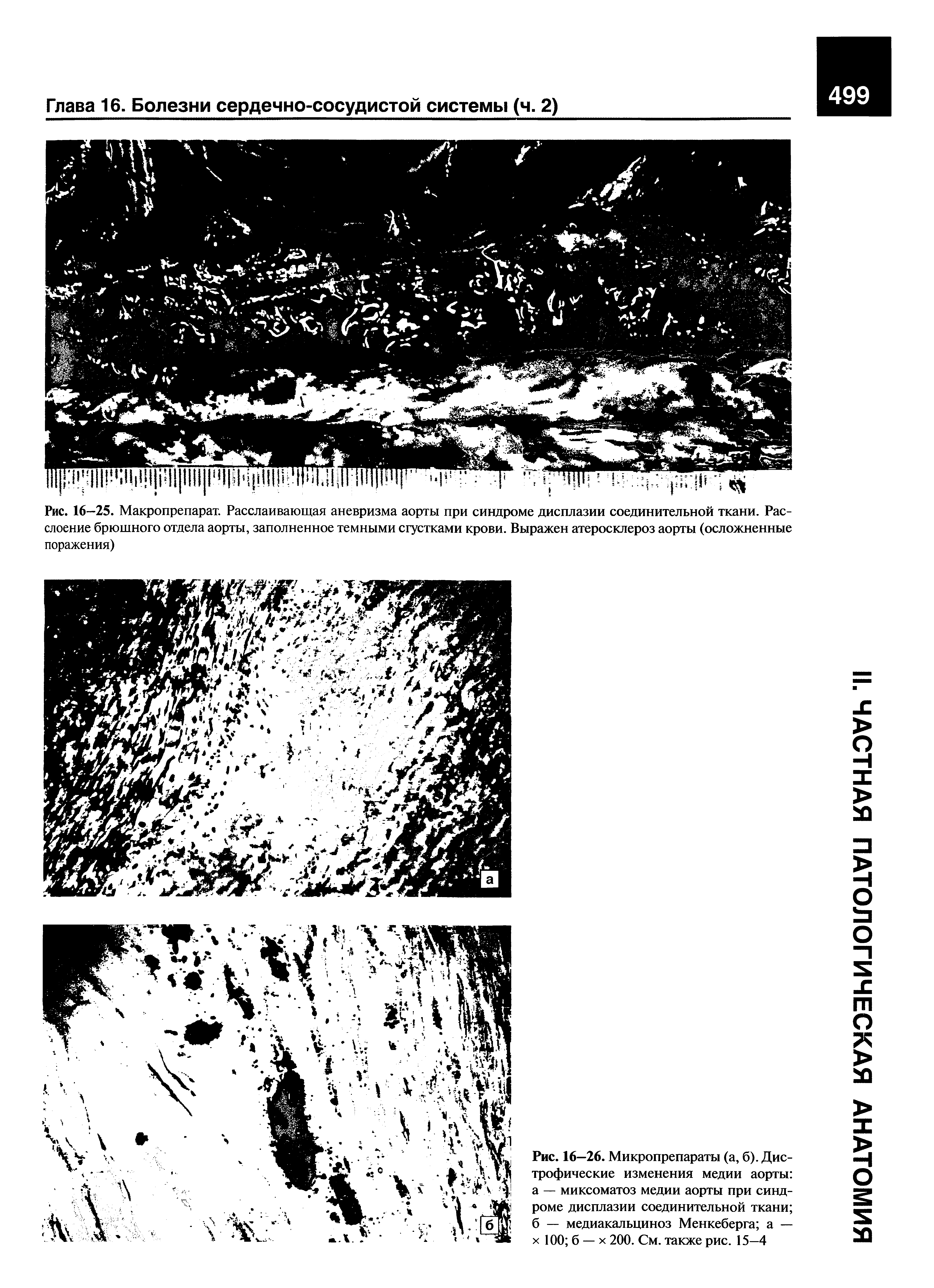 Рис. 16—25. Макропрепарат. Расслаивающая аневризма аорты при синдроме дисплазии соединительной ткани. Расслоение брюшного отдела аорты, заполненное темными сгустками крови. Выражен атеросклероз аорты (осложненные поражения)...