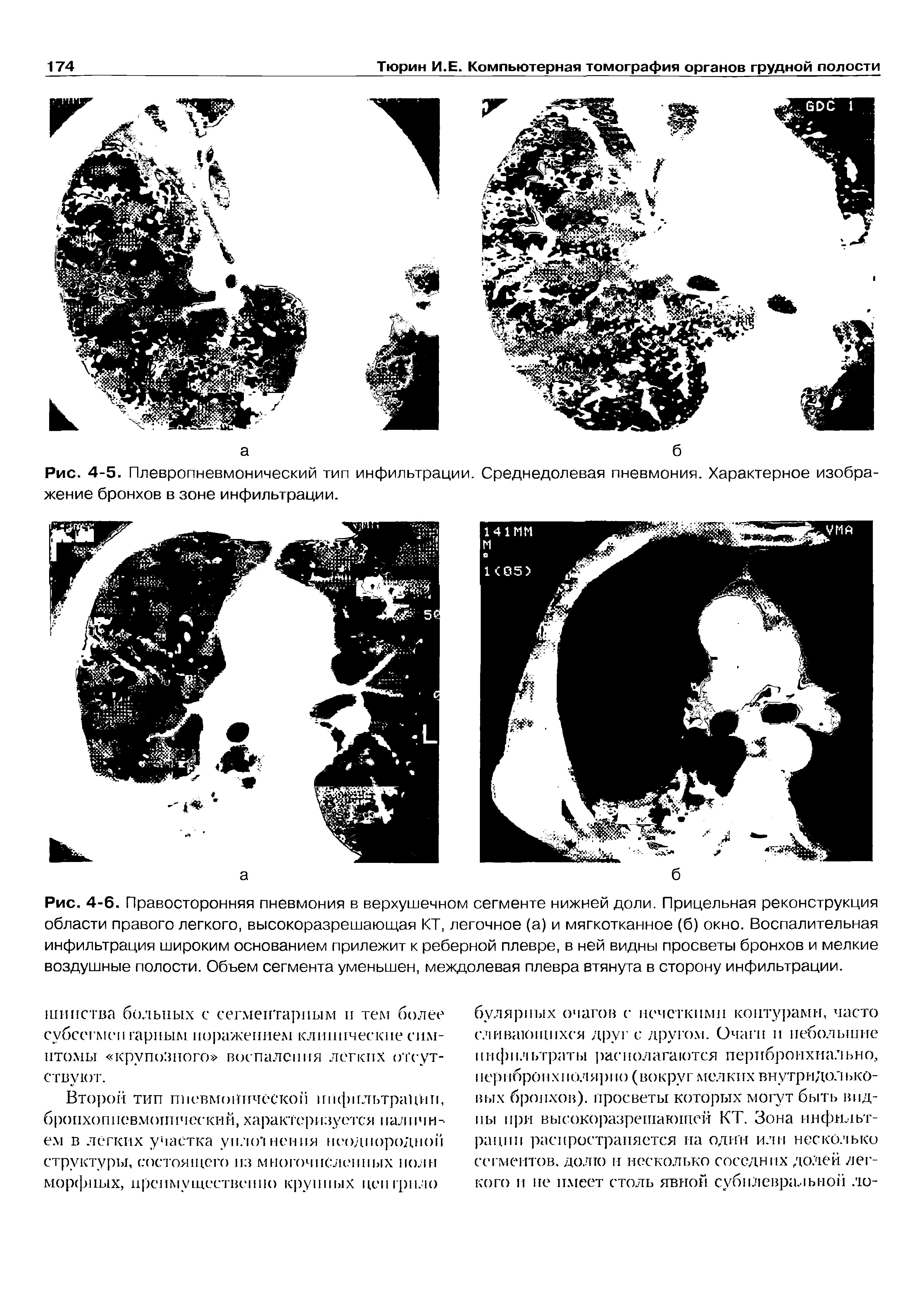 Рис. 4-5. Плевропневмонический тип инфильтрации. Среднедолевая пневмония. Характерное изображение бронхов в зоне инфильтрации.