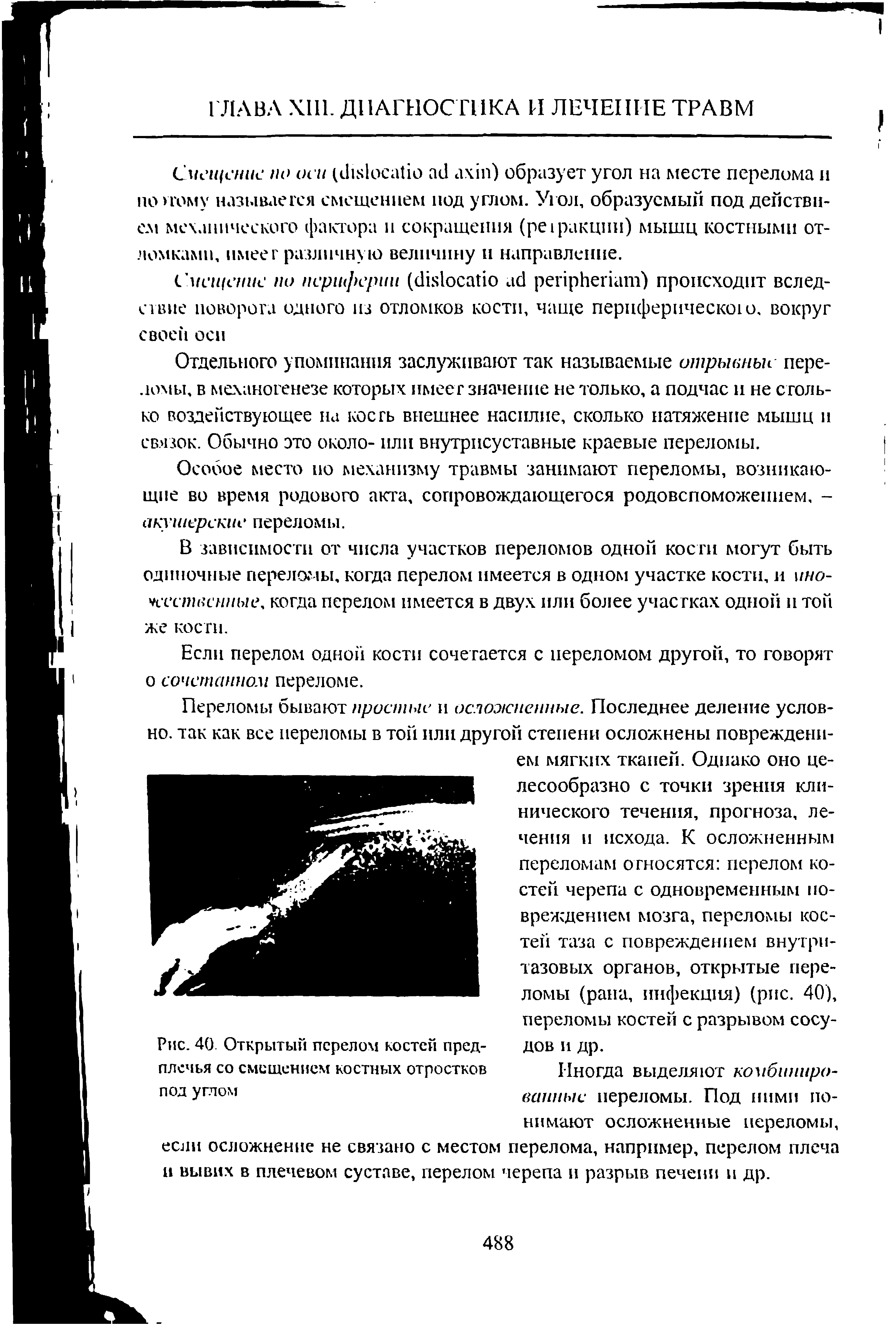 Рис. 40. Открытый перелом костей предплечья со смещением костных отростков под углом...