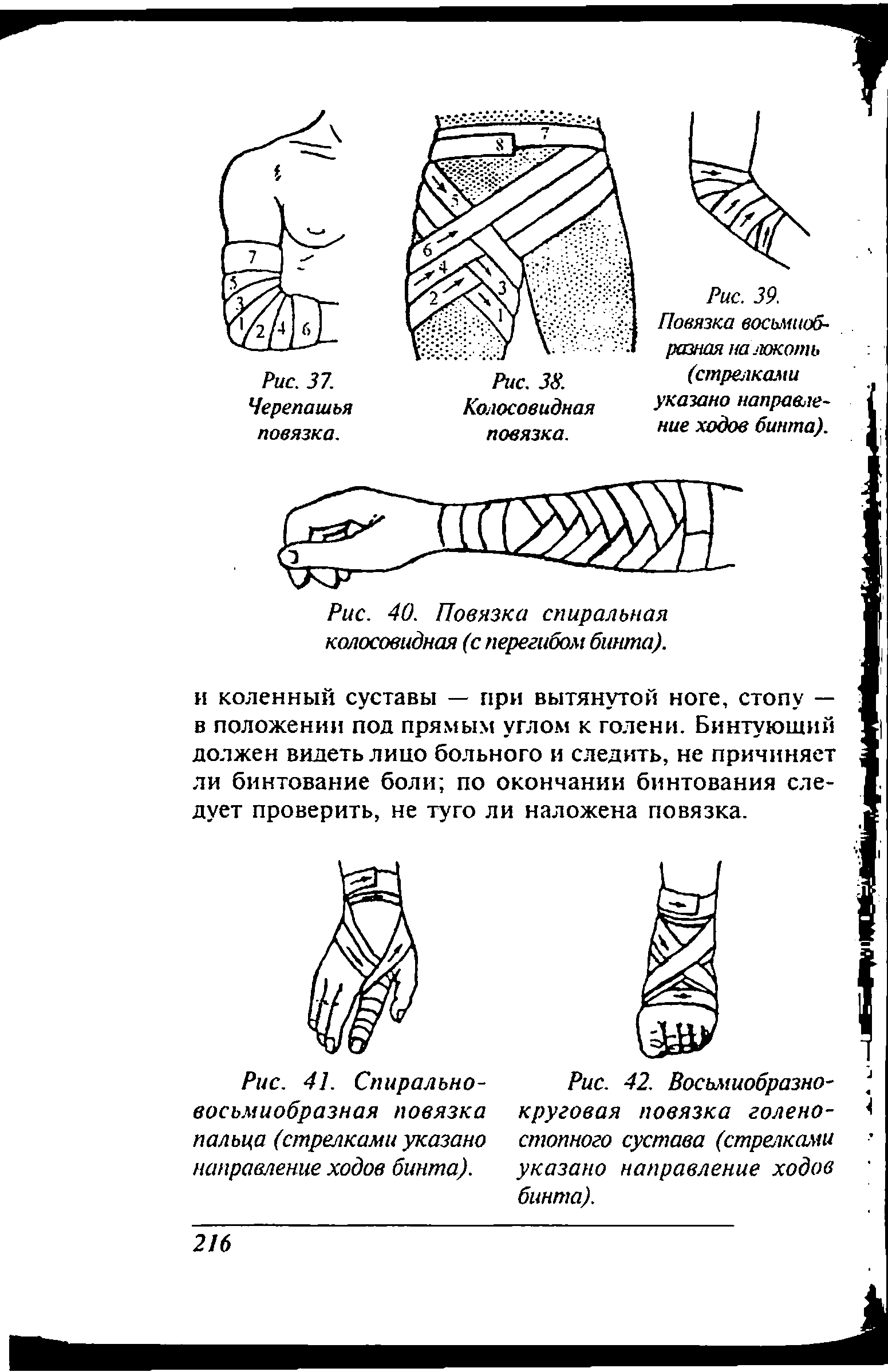 Рис. 42. Восьмиобразнокруговая повязка голеностопного сустава (стрелками указано направление ходов бинта).