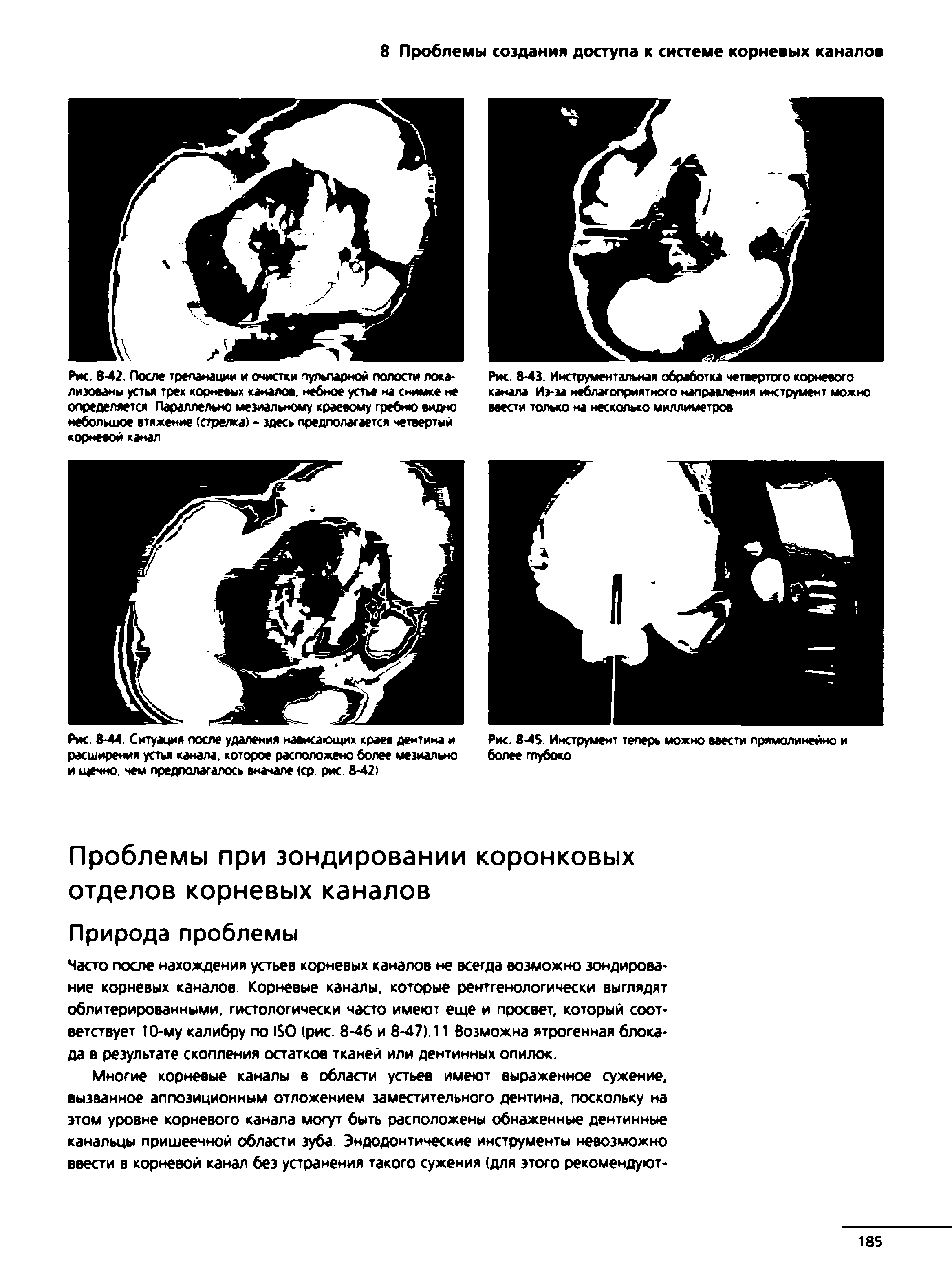 Рис. 8-44. Ситуация после удаления нависающих краев дентина и расширения устья канала, которое расположено более мезиально и щечно. чем предполагалось вначале (ср. рис 8-42)...