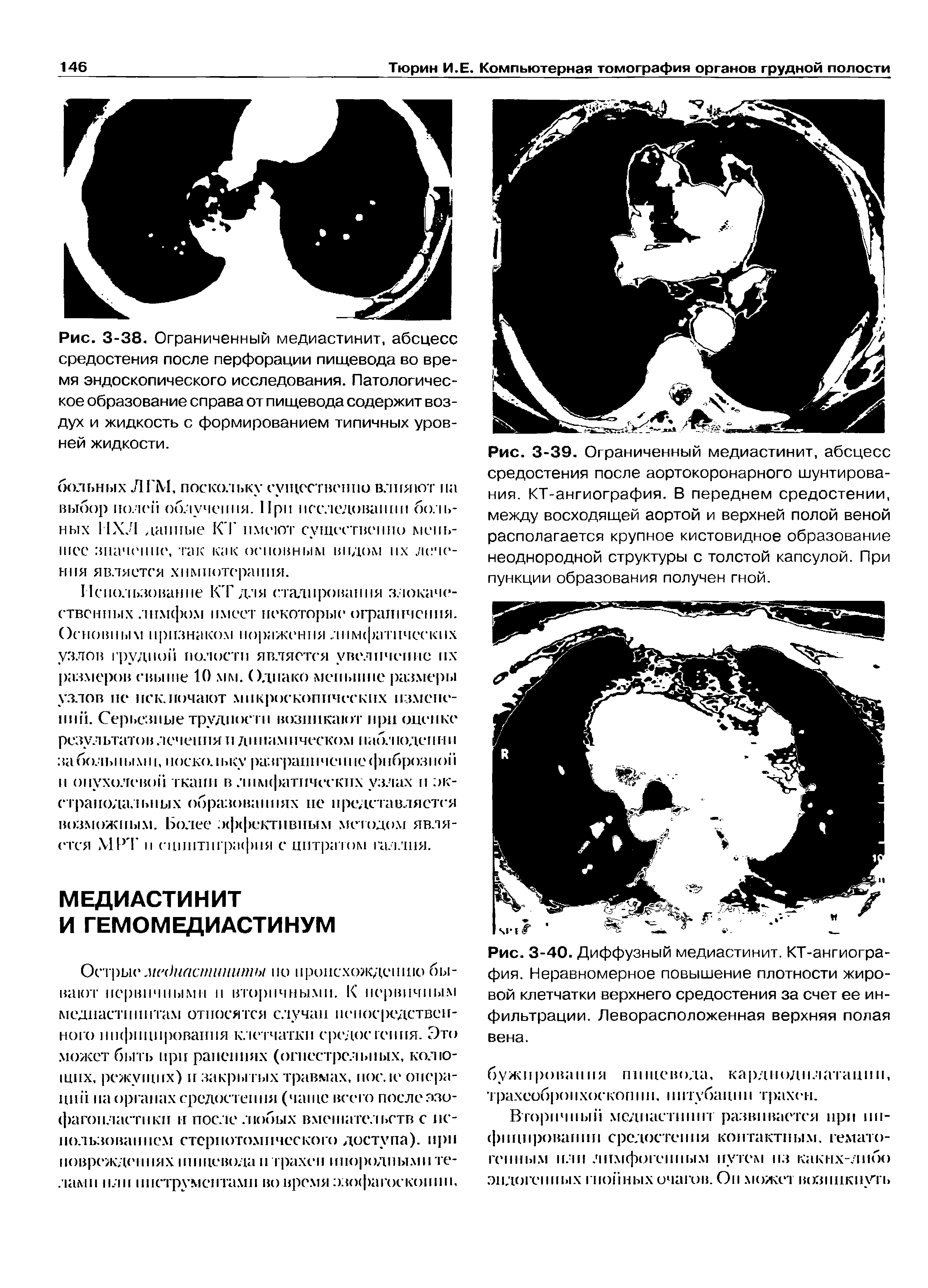 Рис. 3-40. Диффузный медиастинит. КТ-ангиография. Неравномерное повышение плотности жировой клетчатки верхнего средостения за счет ее инфильтрации. Леворасположенная верхняя полая вена.