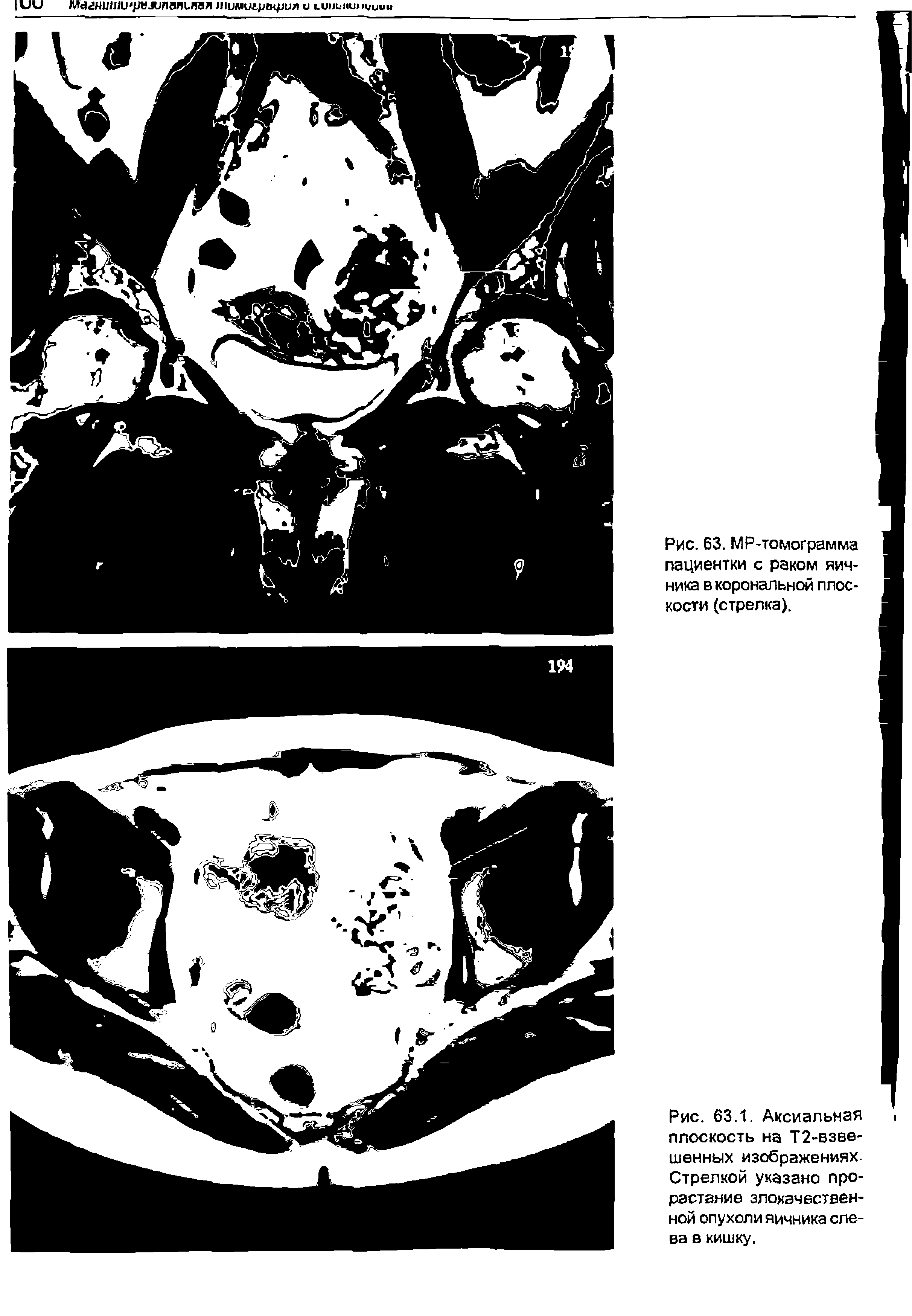 Рис. 63.1. Аксиальная плоскость на Т2-взве-шенных изображениях. Стрелкой указано прорастание злокачественной опухоли яичника слева в кишку.