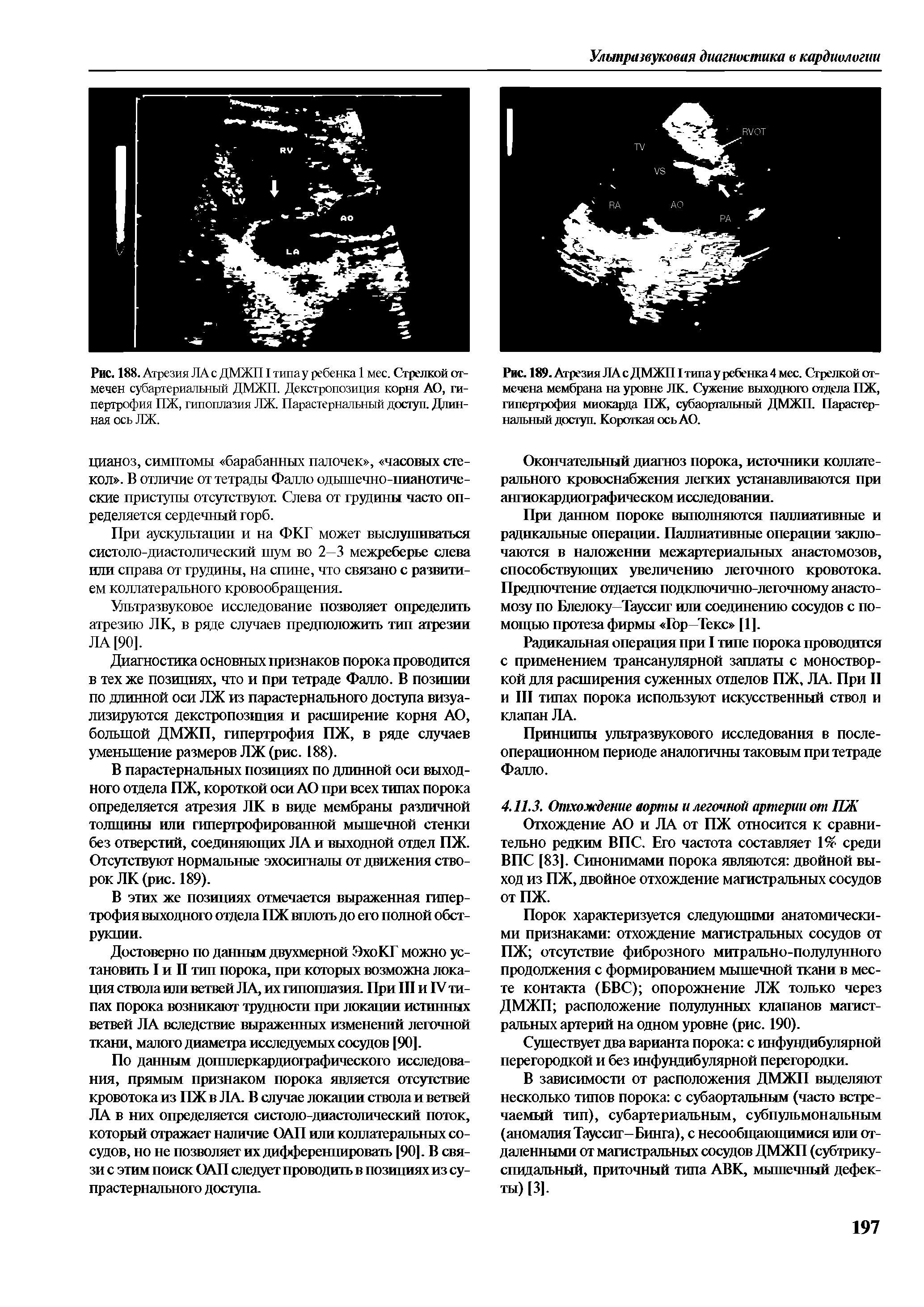 Рис. 189. Атрезия ЛА с ДМЖП I типа у ребенка 4 мес. Стрелкой отмечена мембрана на уровне ЛК. Сужение выходного отдела ПЖ, гипертрофия миокарда ПЖ, субаортальный ДМЖП. Парастернальный доступ. Короткая ось АО.