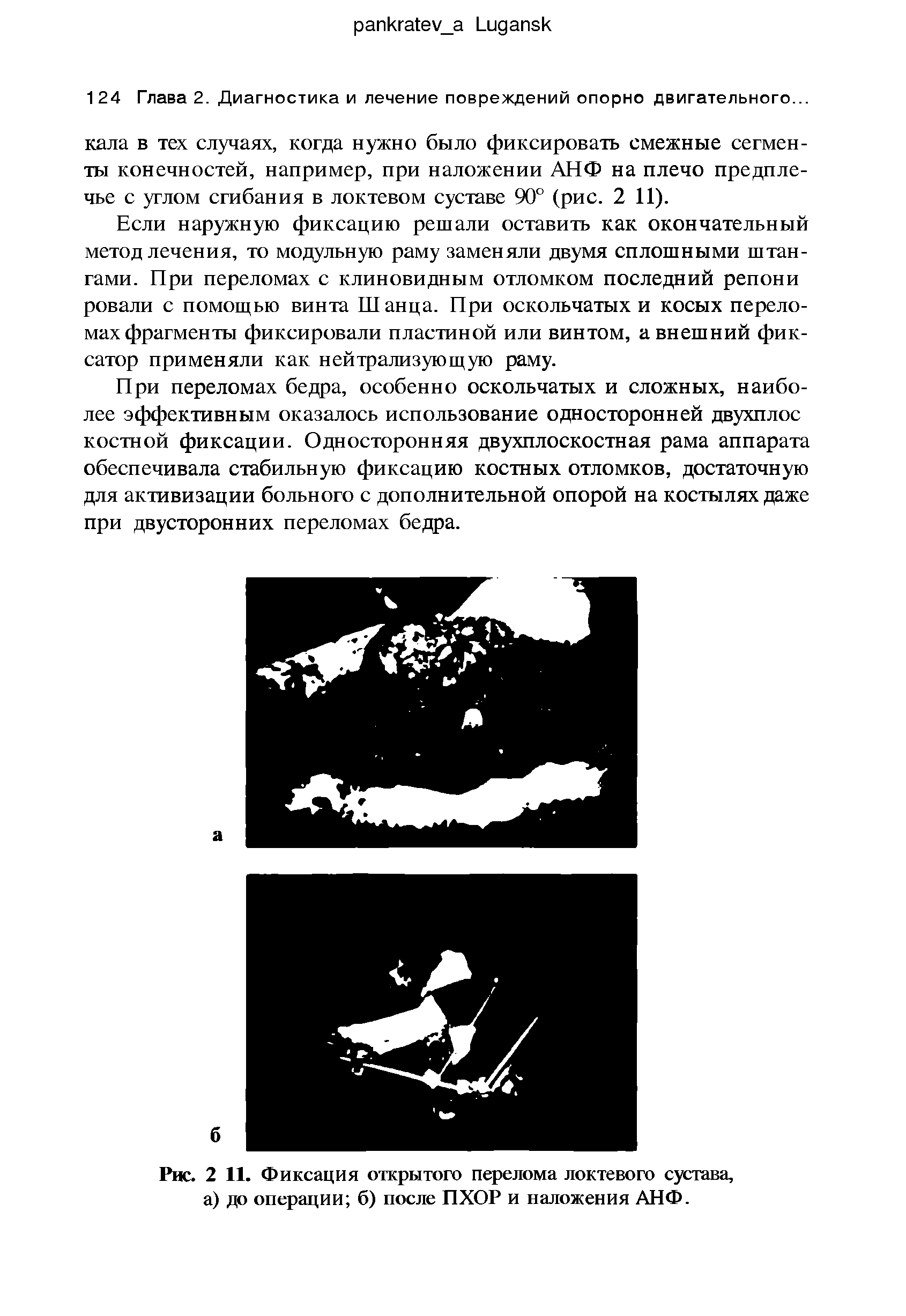 Рис. 2 11. Фиксация открытого перелома локтевого сустава, а) до операции б) после ПХОР и наложения АНФ.