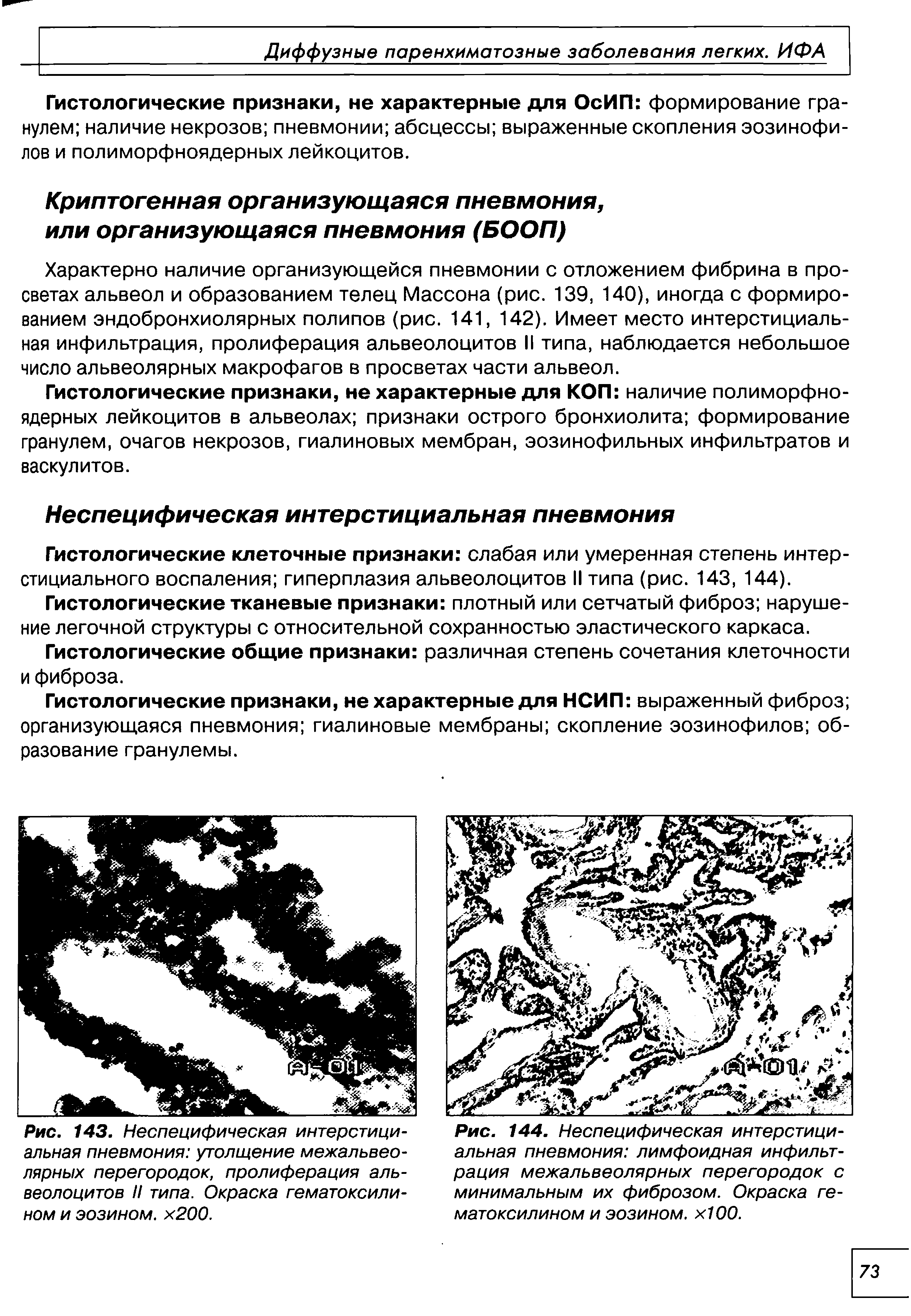 Рис. 144. Неспецифическая интерстициальная пневмония лимфоидная инфильтрация межальвеолярных перегородок с минимальным их фиброзом. Окраска гематоксилином и эозином. хЮО.