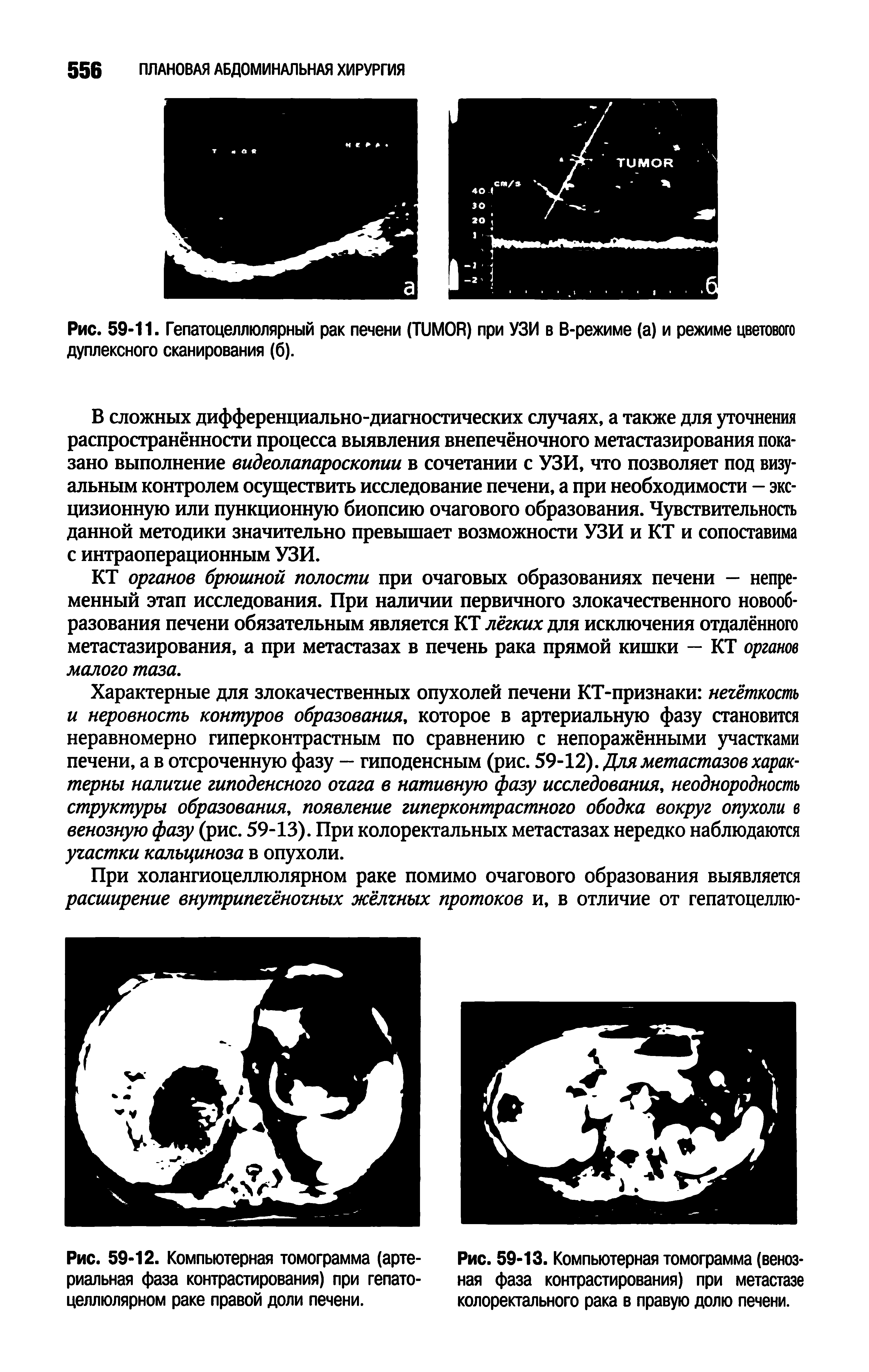 Рис. 59-11. Гепатоцеллюлярный рак печени (TUMOR) при УЗИ в В-режиме (а) и режиме цветового дуплексного сканирования (б).