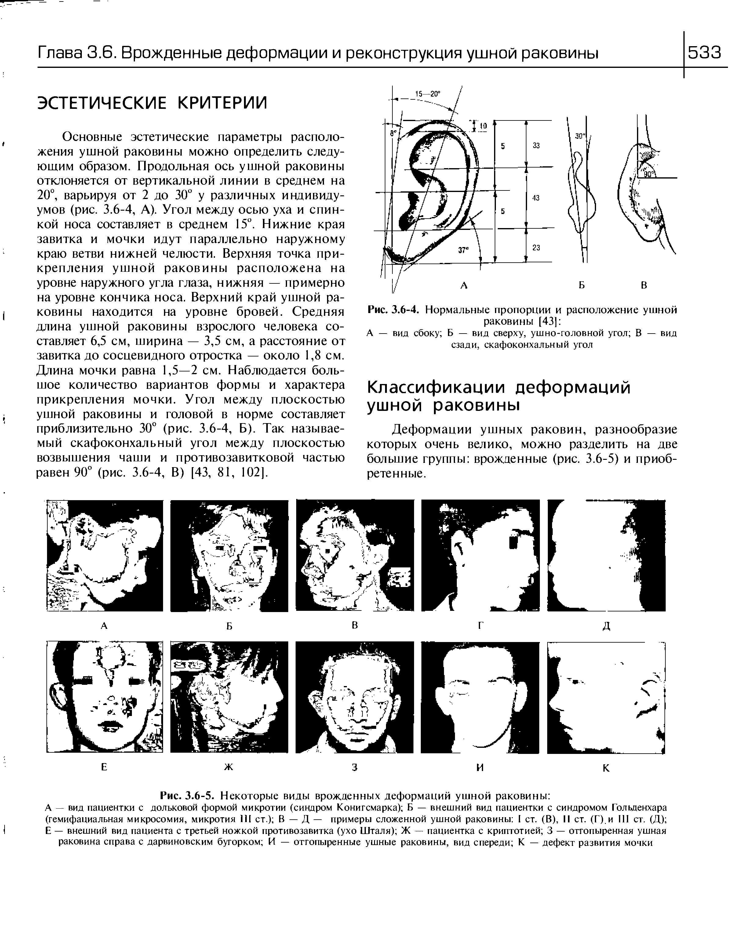 Рис. 3.6-5. Некоторые виды врожденных деформаций ушной раковины ...