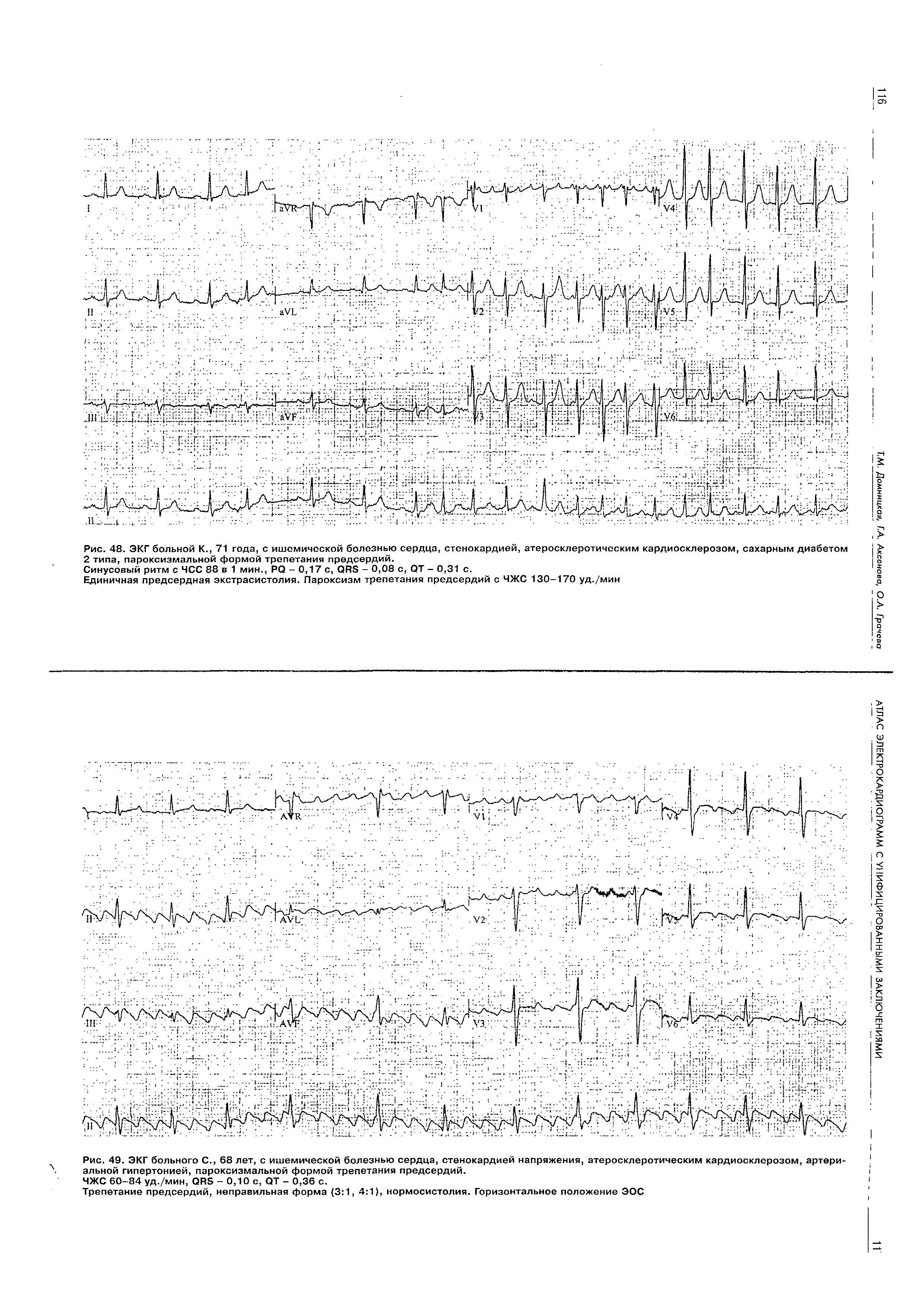 Рис. 49. ЭКГ больного С., 68 лет, с ишемической болезнью сердца, стенокардией напряжения, атеросклеротическим кардиосклерозом, артериальной гипертонией, пароксизмальной формой трепетания предсердий.