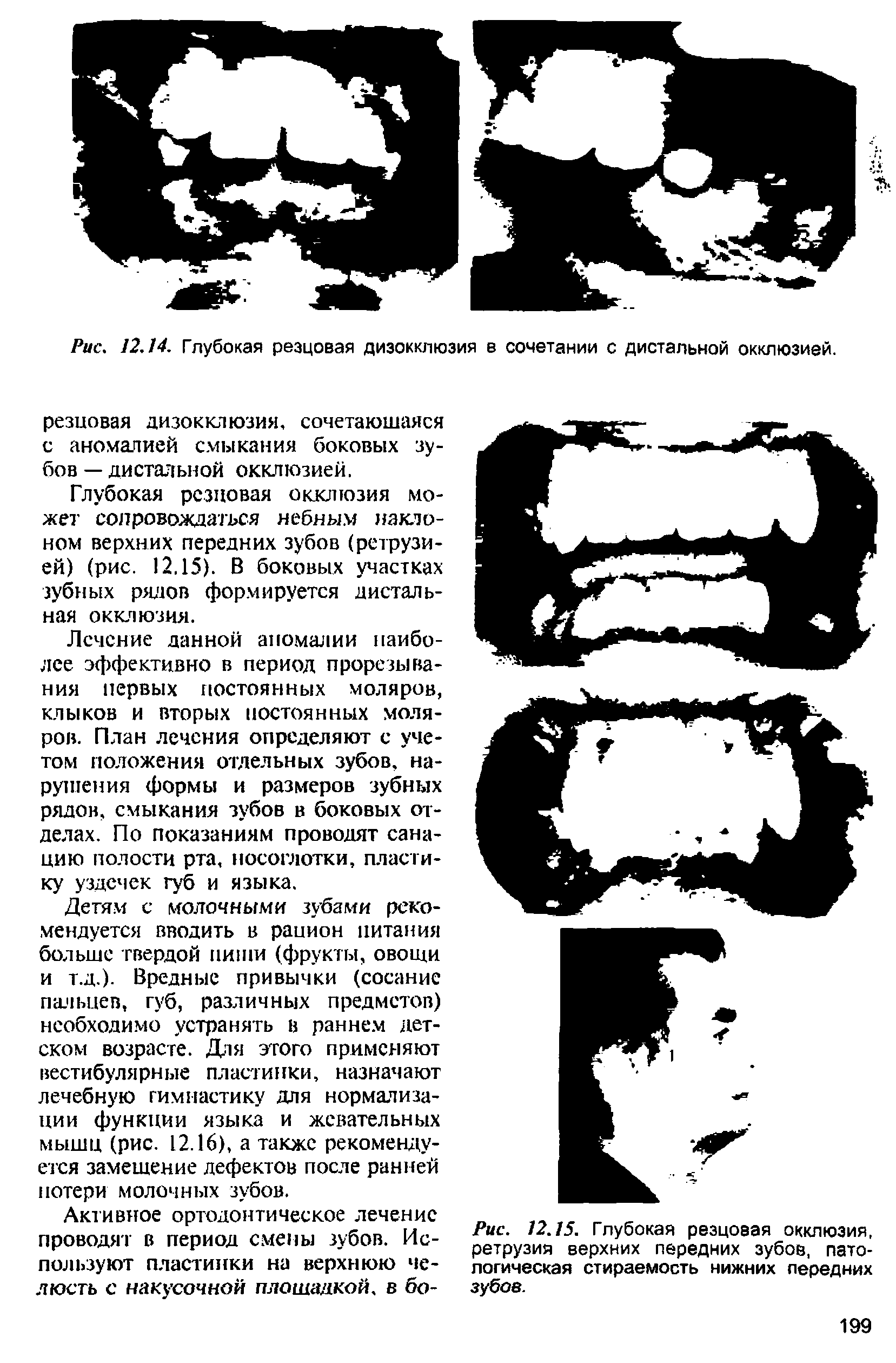 Рис. 12.15. Глубокая резцовая окклюзия, ретрузия верхних передних зубов, патологическая стираемость нижних передних зубов.