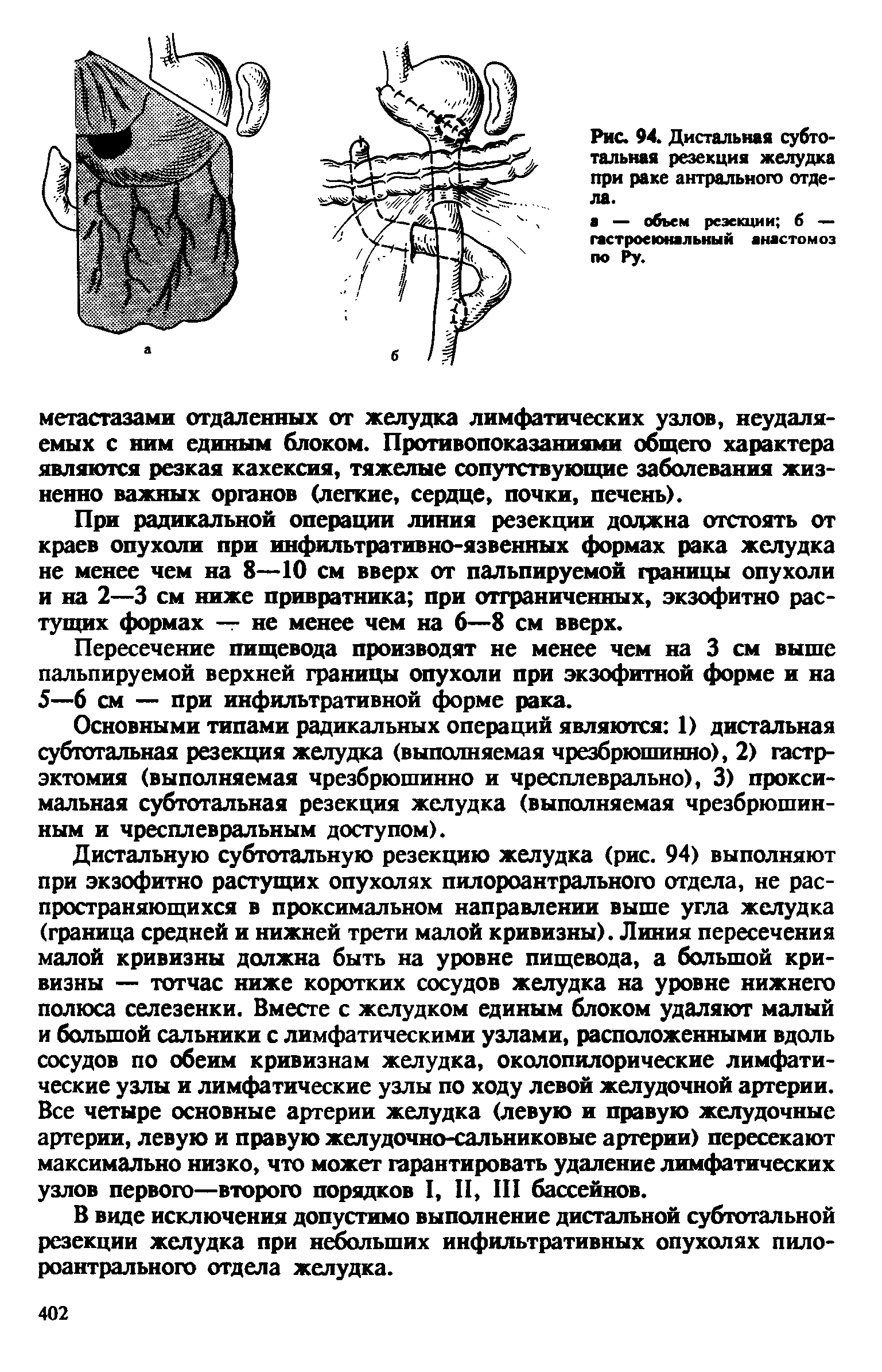 Рис. 94. Дистальная субтотальная резекция желудка при раке антрального отдела.