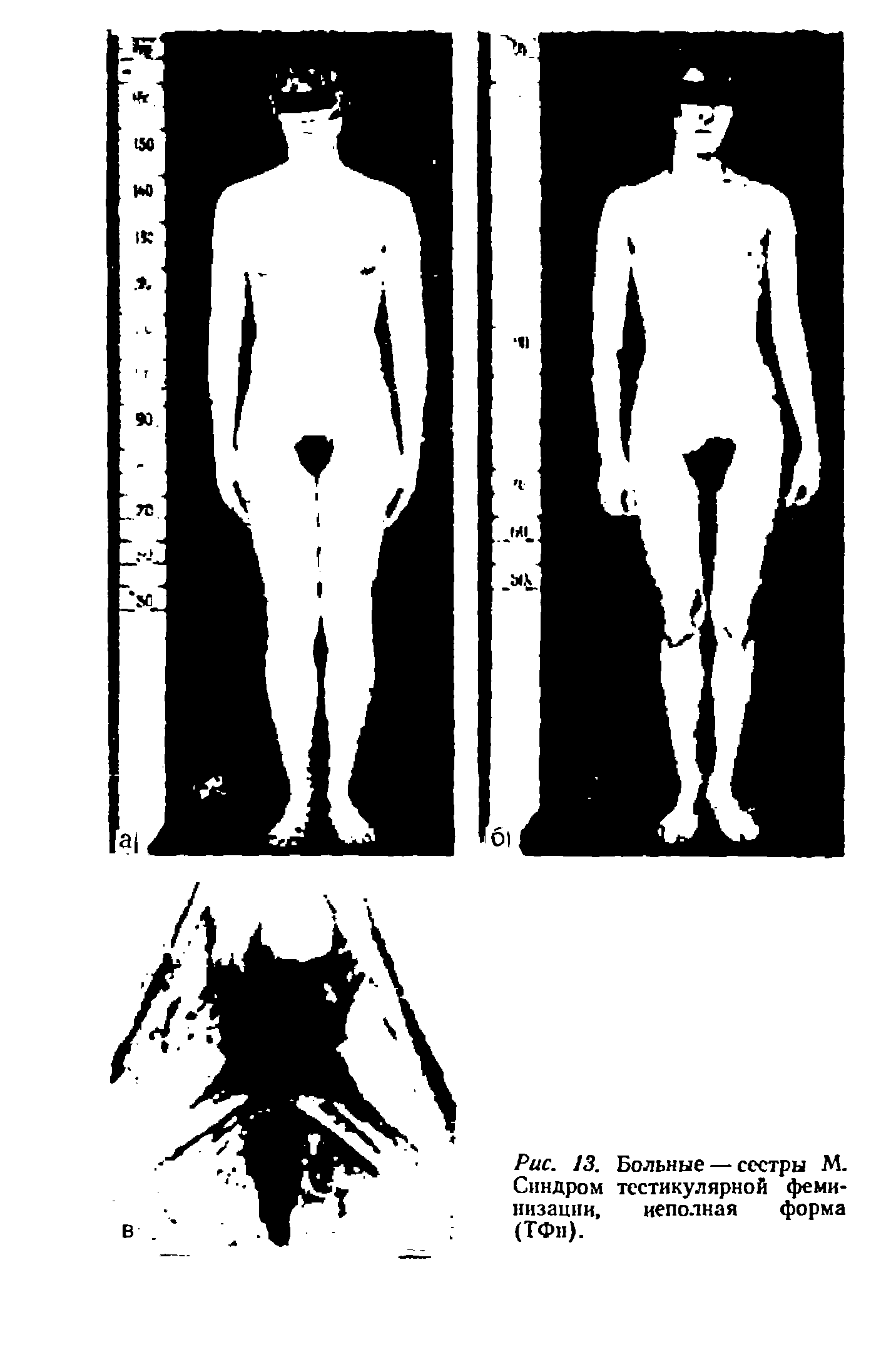 Рис. 13. Больные — сестры М. Синдром тестикулярной феминизации, неполная форма (ТФп).