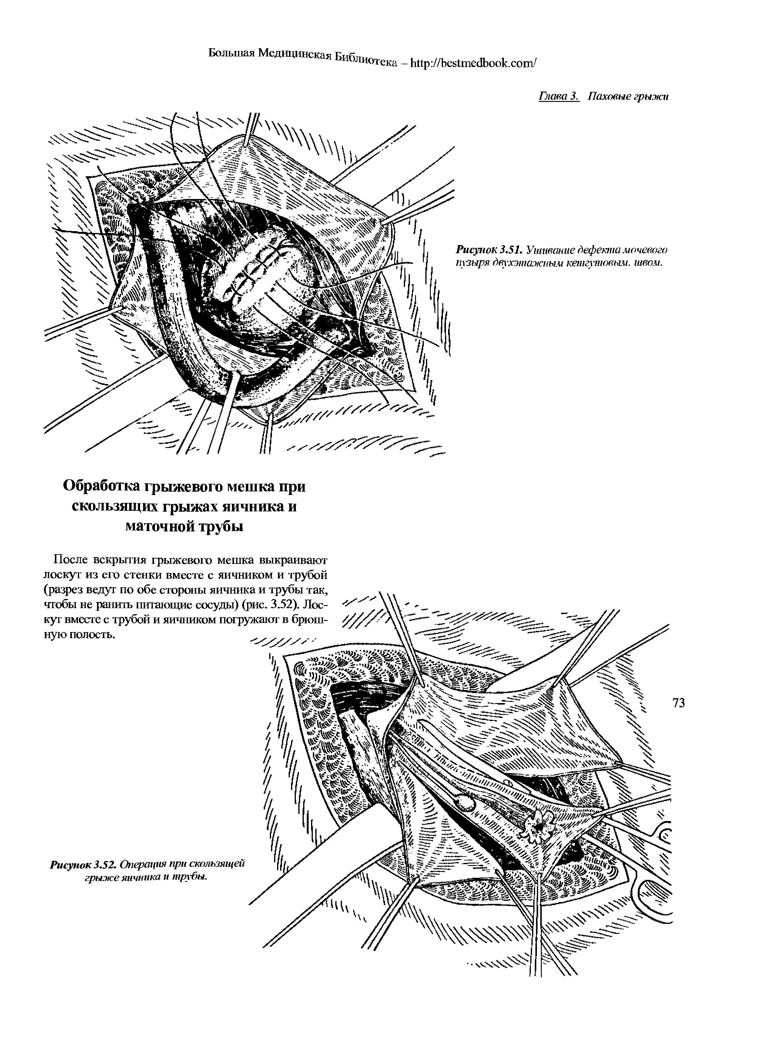 Рисунок 3.52. Операция при скользящей грыже яичника и трубы.