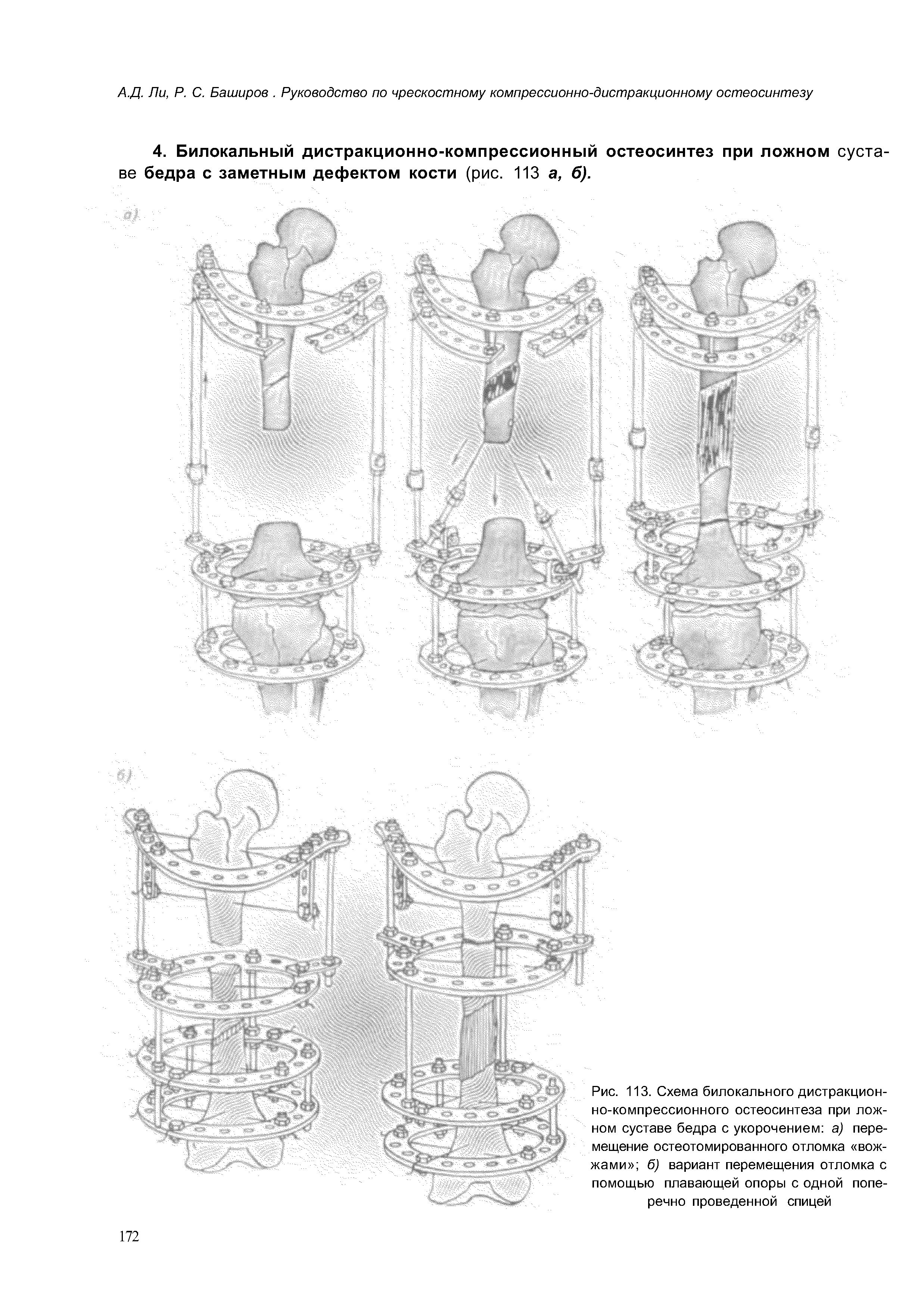 Рис. 113. Схема билокального дистракционно-компрессионного остеосинтеза при ложном суставе бедра с укорочением а) перемещение остеотомированного отломка вожжами 6) вариант перемещения отломка с помощью плавающей опоры с одной поперечно проведенной спицей...