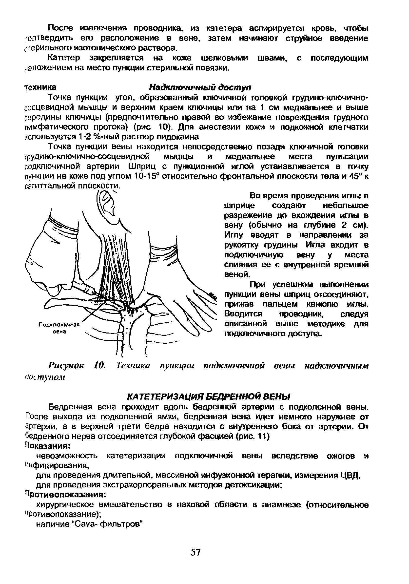 Рисунок 10. Техника пункции подключичной вены надключичным тупом...