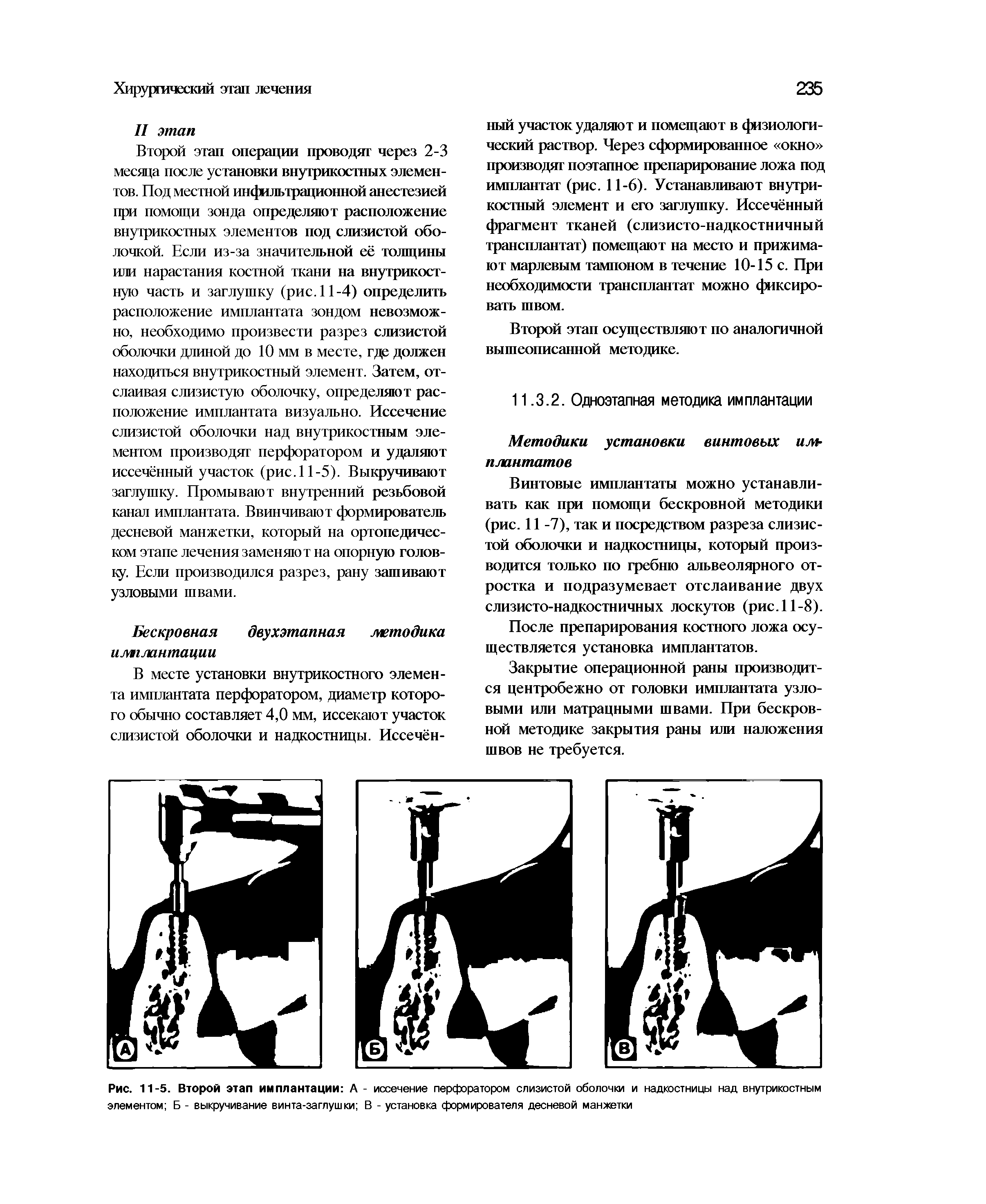 Рис. 11-5. Второй этап имплантации А - иссечение перфоратором слизистой оболочки и надкостницы над внутрикостным элементом Б - выкручивание винта-заглушки В - установка формирователя десневой манжетки...