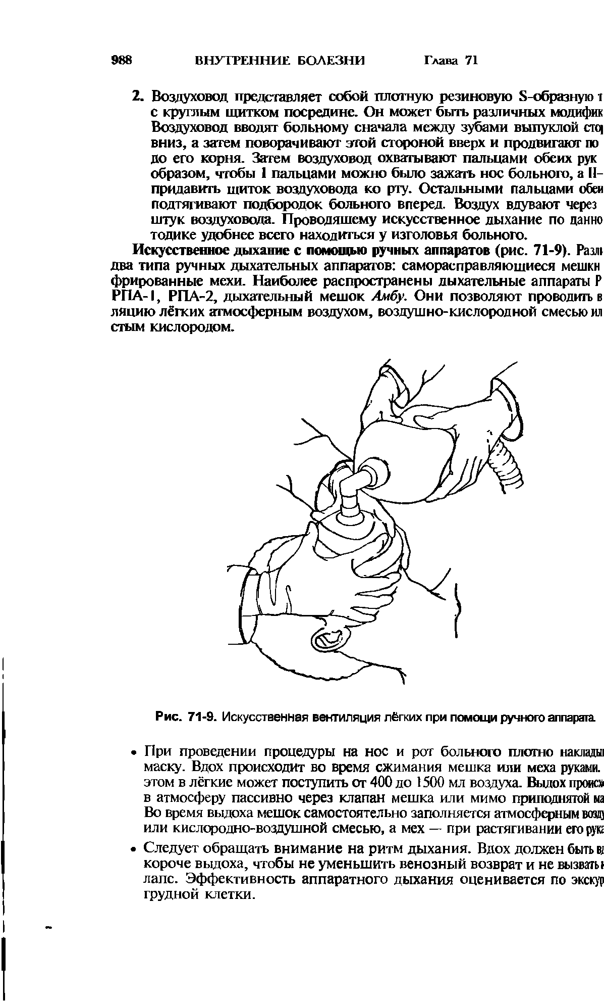 Рис. 71-9. Искусственная вентиляция лёгких при помощи ручного аппарата.