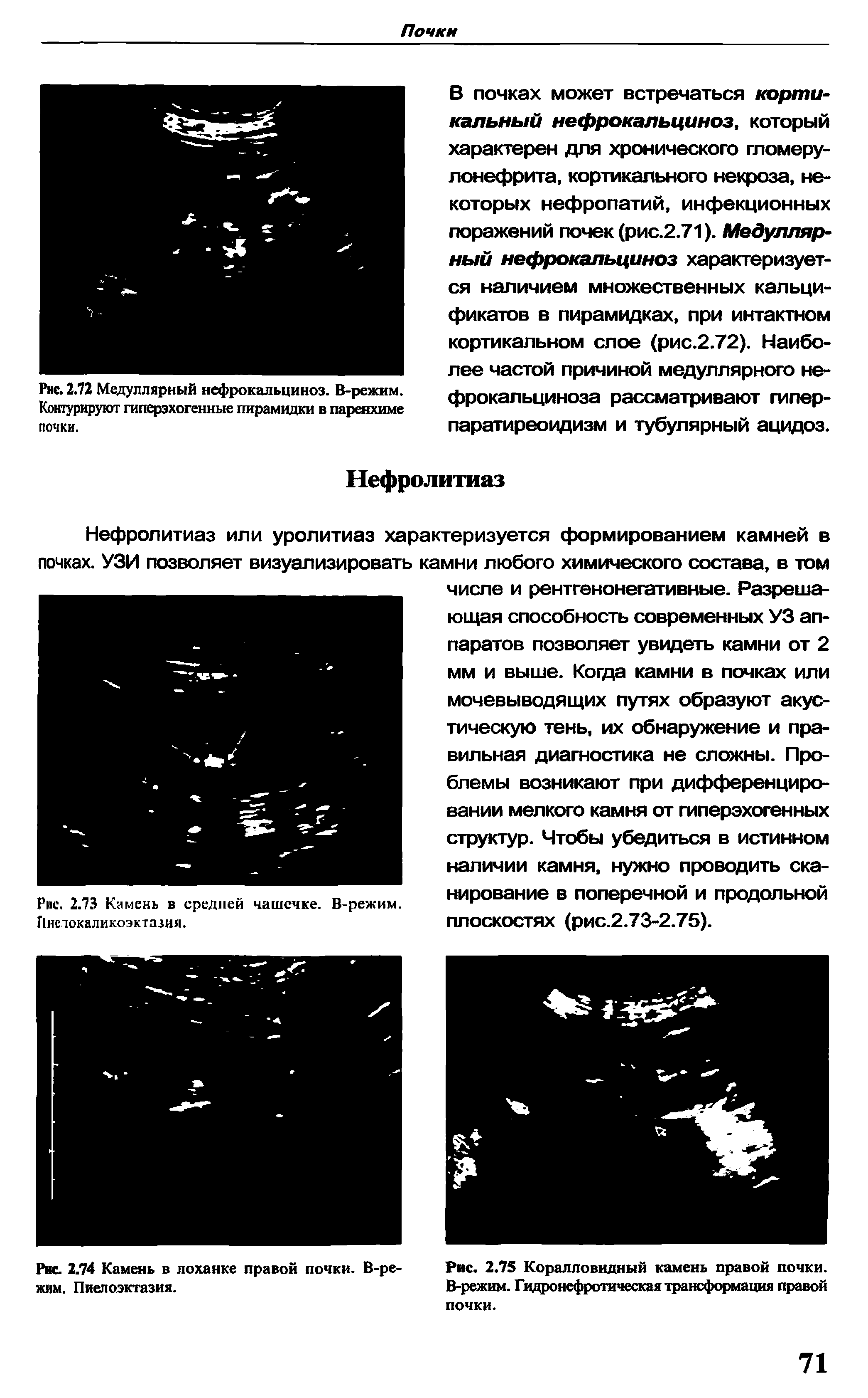 Рис. 2.75 Коралловидный камень правой почки. В-режим. Гидронефротическая трансформация правой почки.