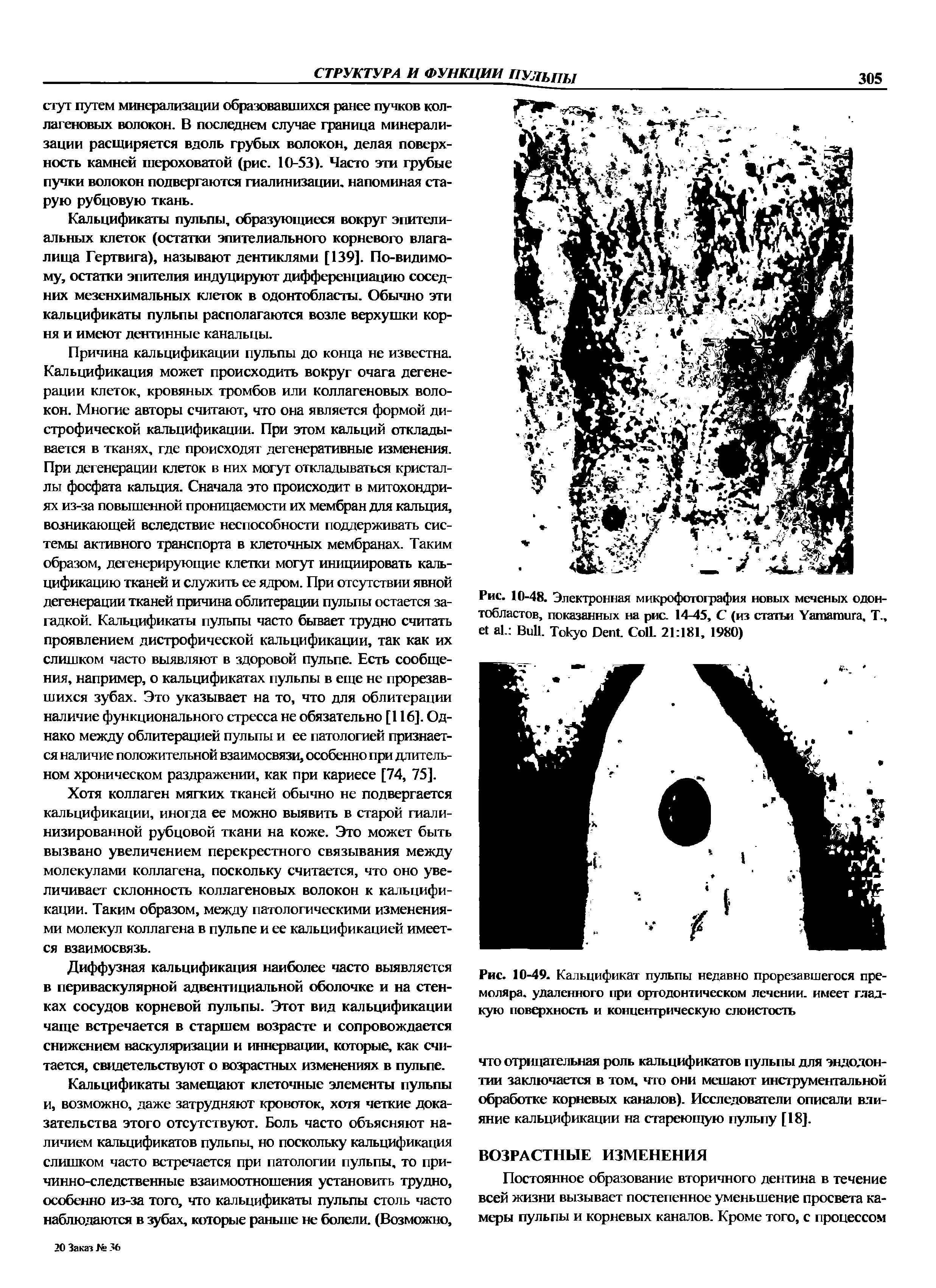 Рис. 10-49. Кальцификат пульпы недавно прорезавшегося премоляра. удаленного при ортодонтическом лечении, имеет гладкую поверхность и концентрическую слоистость...