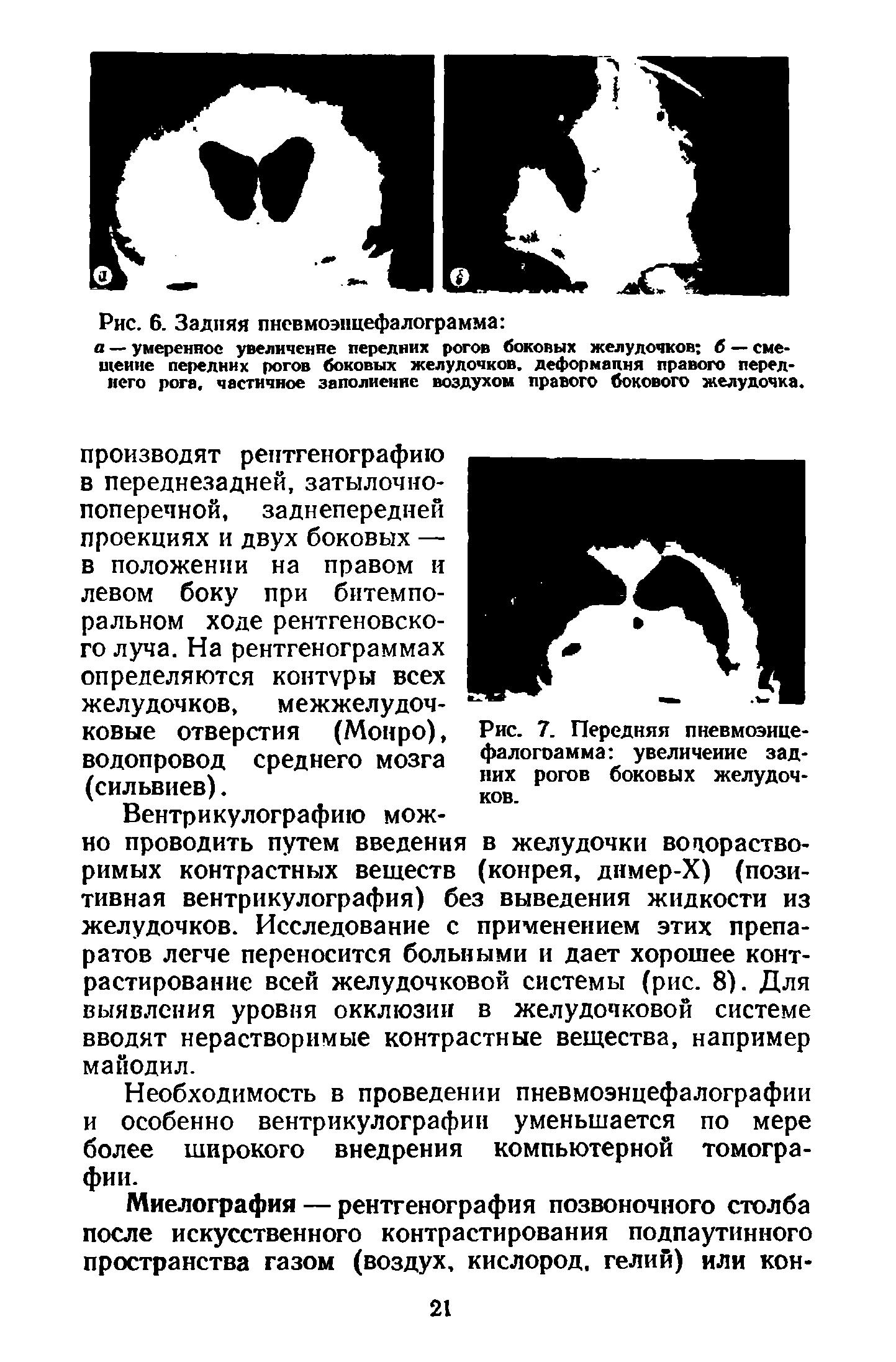 Рис. 7. Передняя пневмоэице-фалогоамма увеличение задних рогов боковых желудочков.