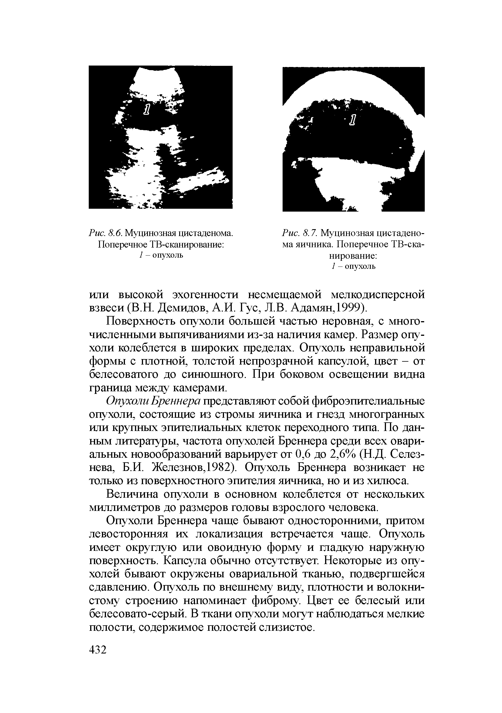 Рис. 8.7. Муцинозная цистаденома яичника. Поперечное ТВ-сканирование 1 - опухоль...