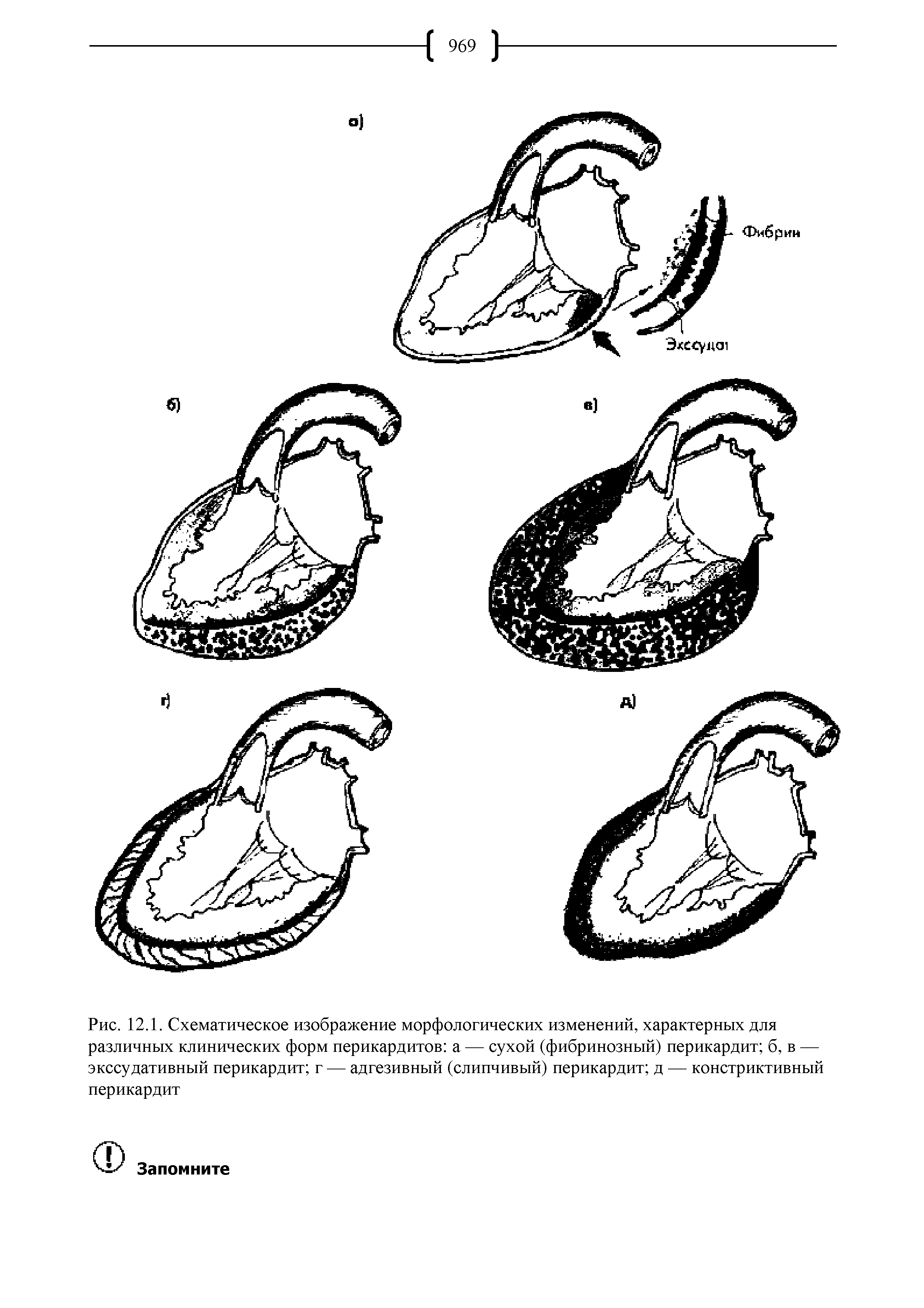 Рис. 12.1. Схематическое изображение морфологических изменений, характерных для различных клинических форм перикардитов а — сухой (фибринозный) перикардит б, в — экссудативный перикардит г — адгезивный (слипчивый) перикардит д — констриктивный перикардит...