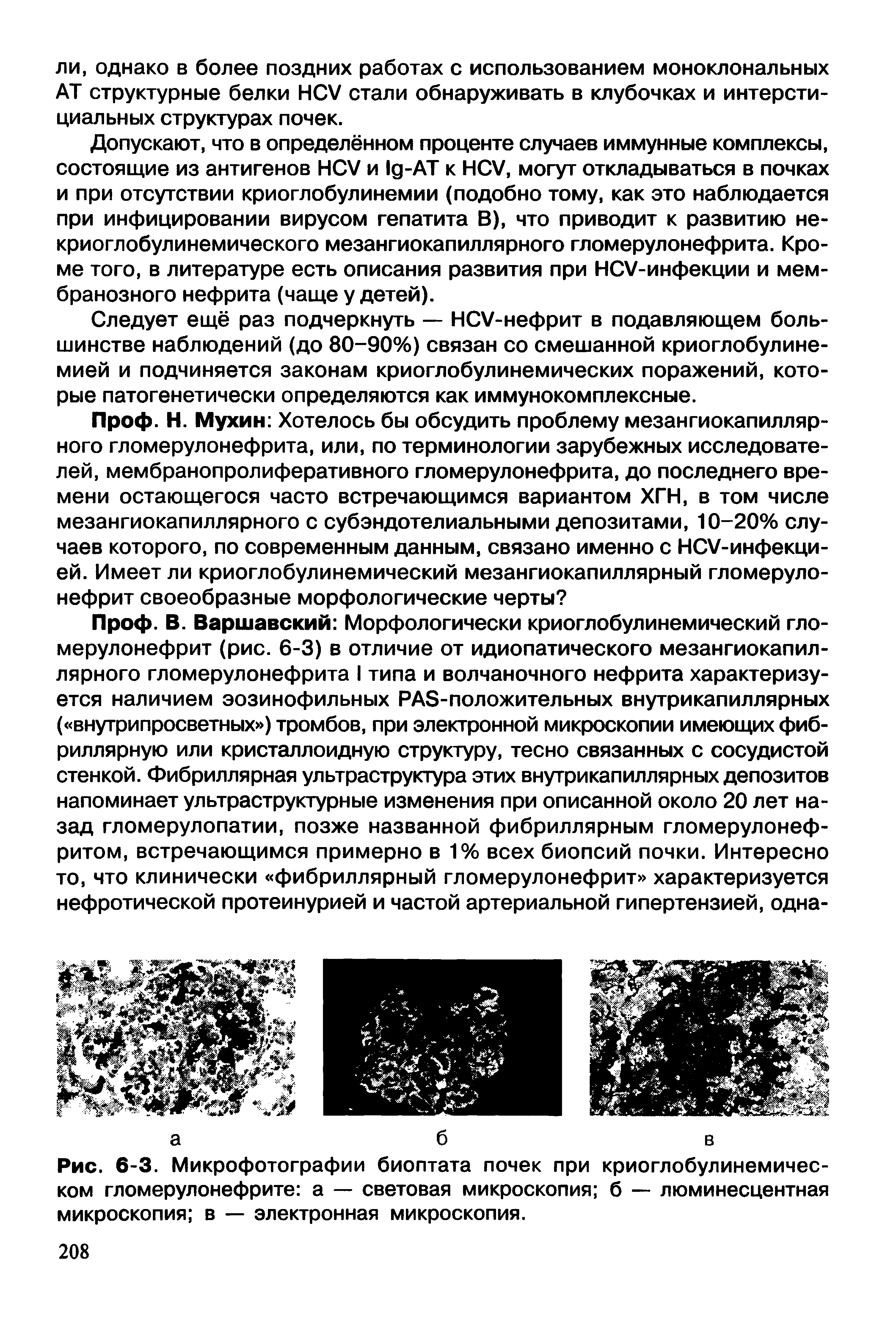 Рис. 6-3. Микрофотографии биоптата почек при криоглобулинемическом гломерулонефрите а — световая микроскопия б — люминесцентная микроскопия в — электронная микроскопия.