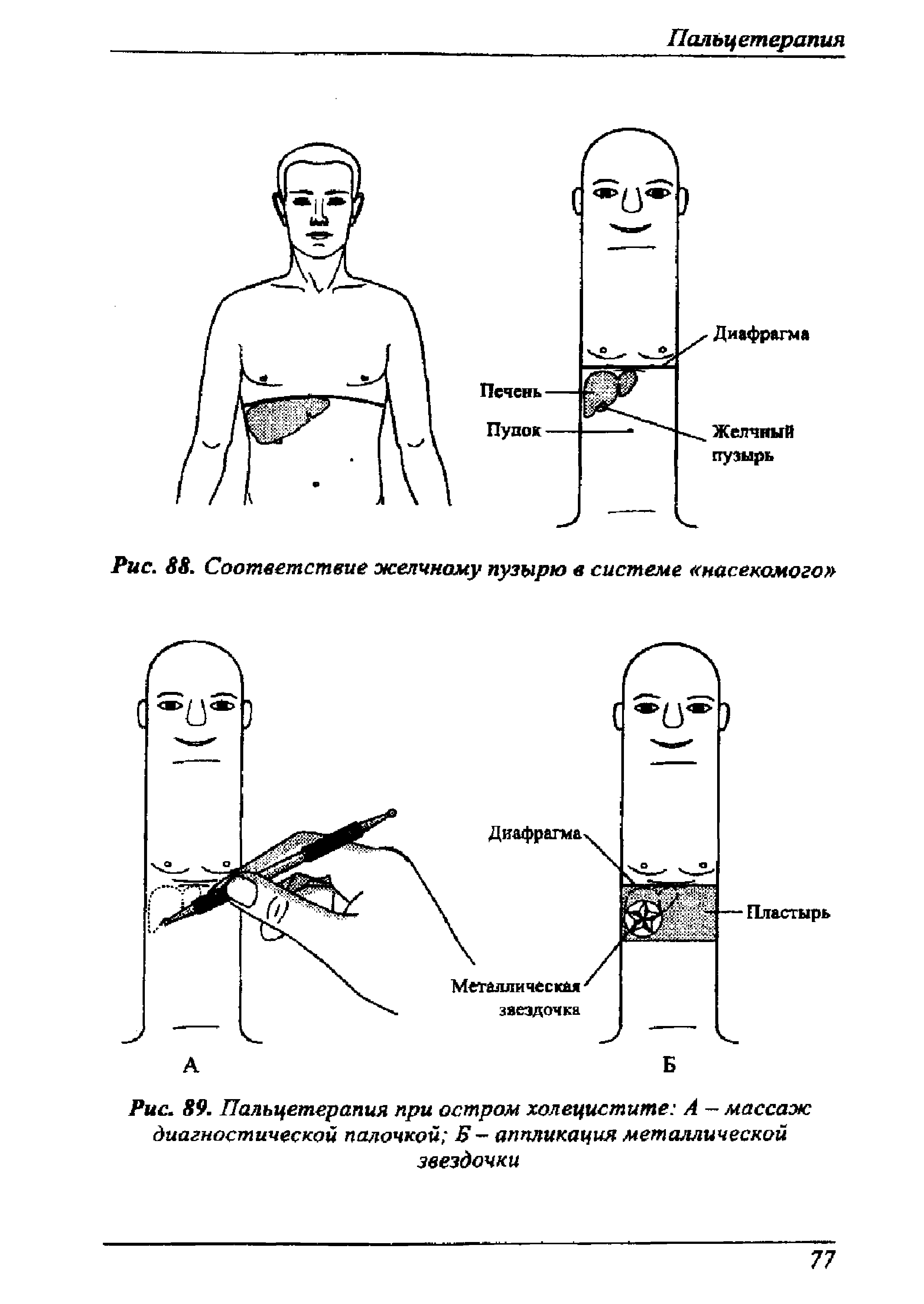 Рис. 89. Пальцетерапия при остром холецистите А массаж диагностической палочкой Я — аппликация металлической звездочки...
