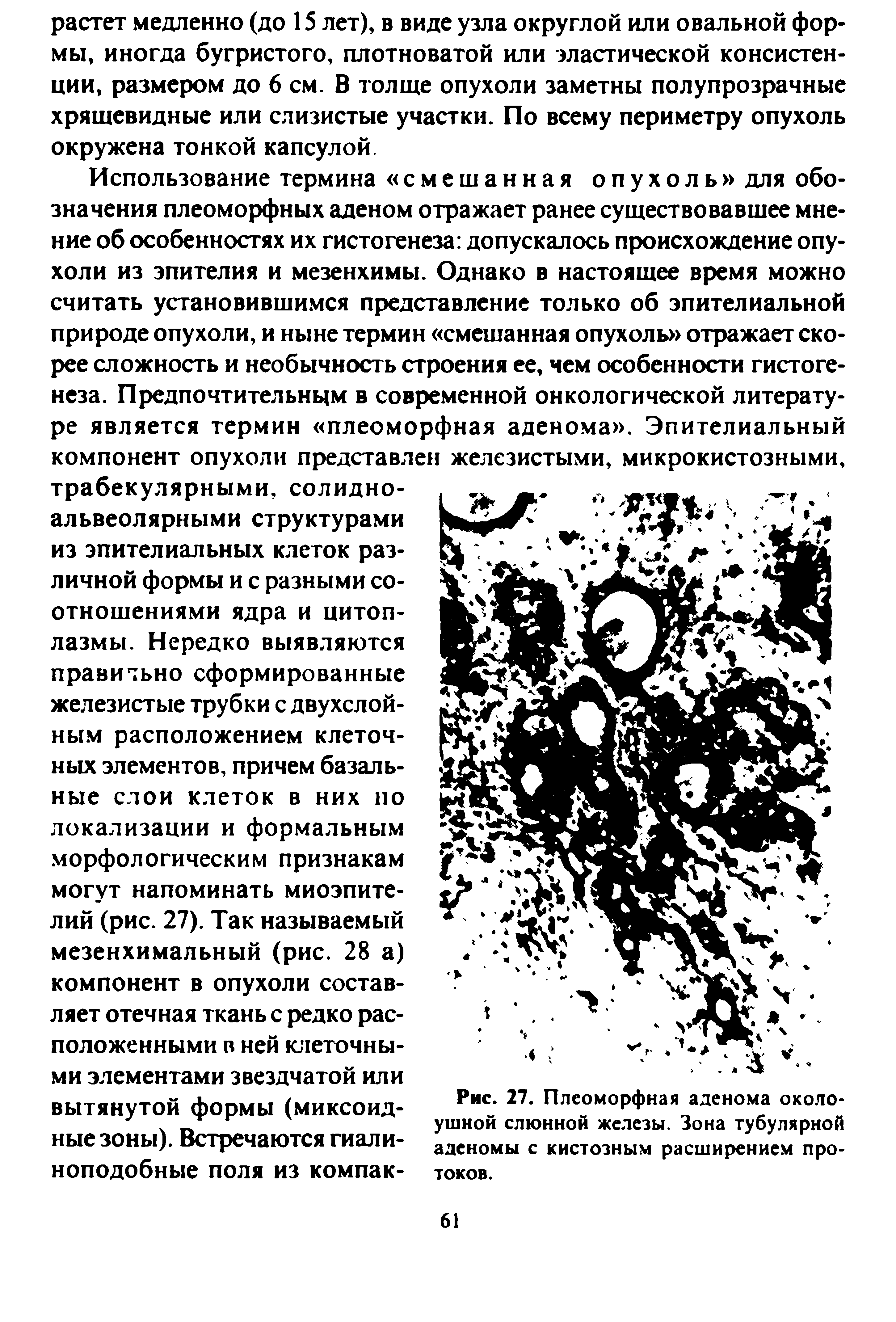 Рис. 27. Плеоморфная аденома околоушной слюнной железы. Зона тубулярной аденомы с кистозным расширением протоков.