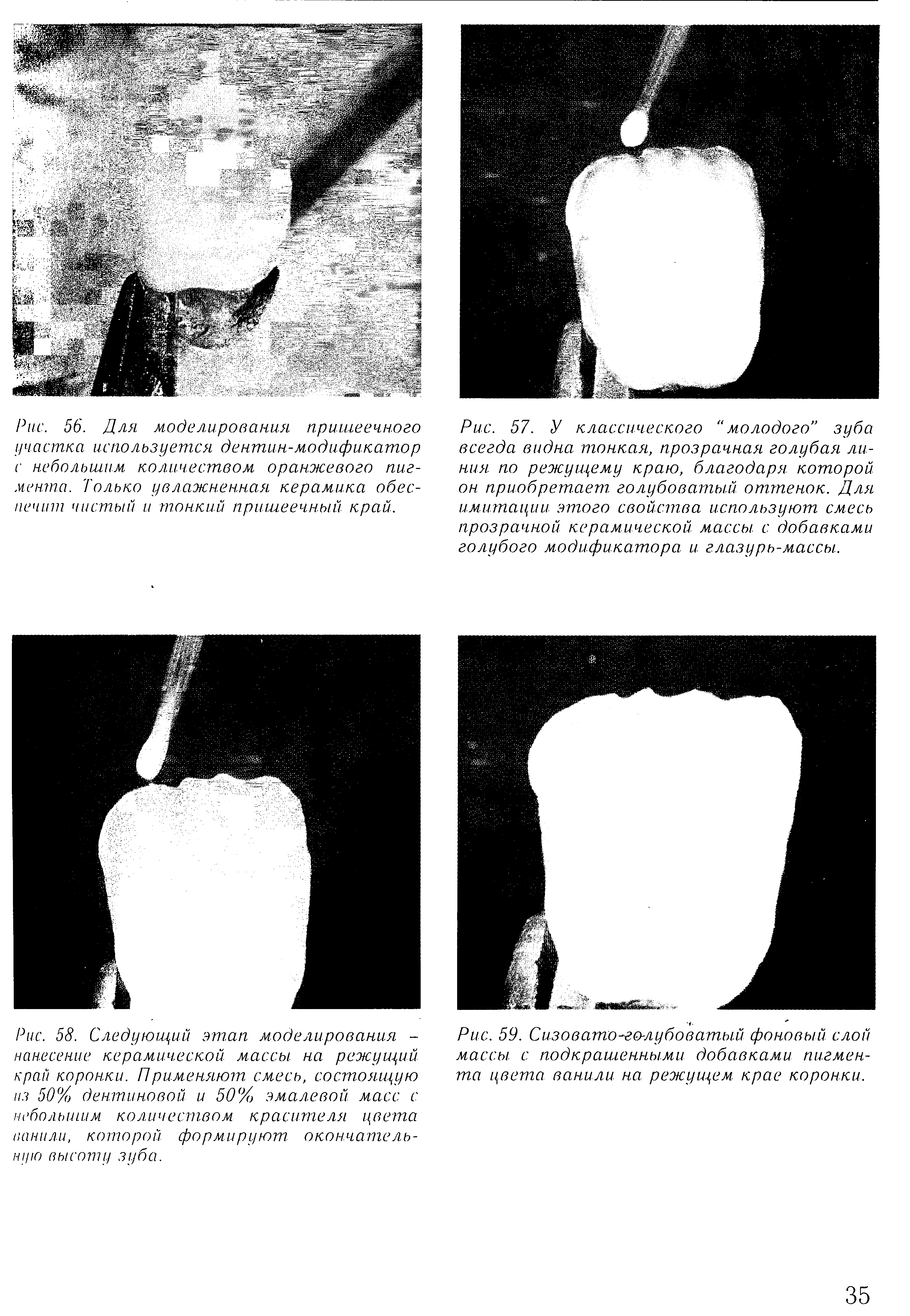 Рис. 58. Следующий этап моделирования -нанесение керамической, массы, на режущий край коронки. Применяют смесь, состоящую из 50% дентиновой и 50%) эмалевой масс с небольшим количеством красителя цвета ванили, которой формируют, окончательную высоту зуба.