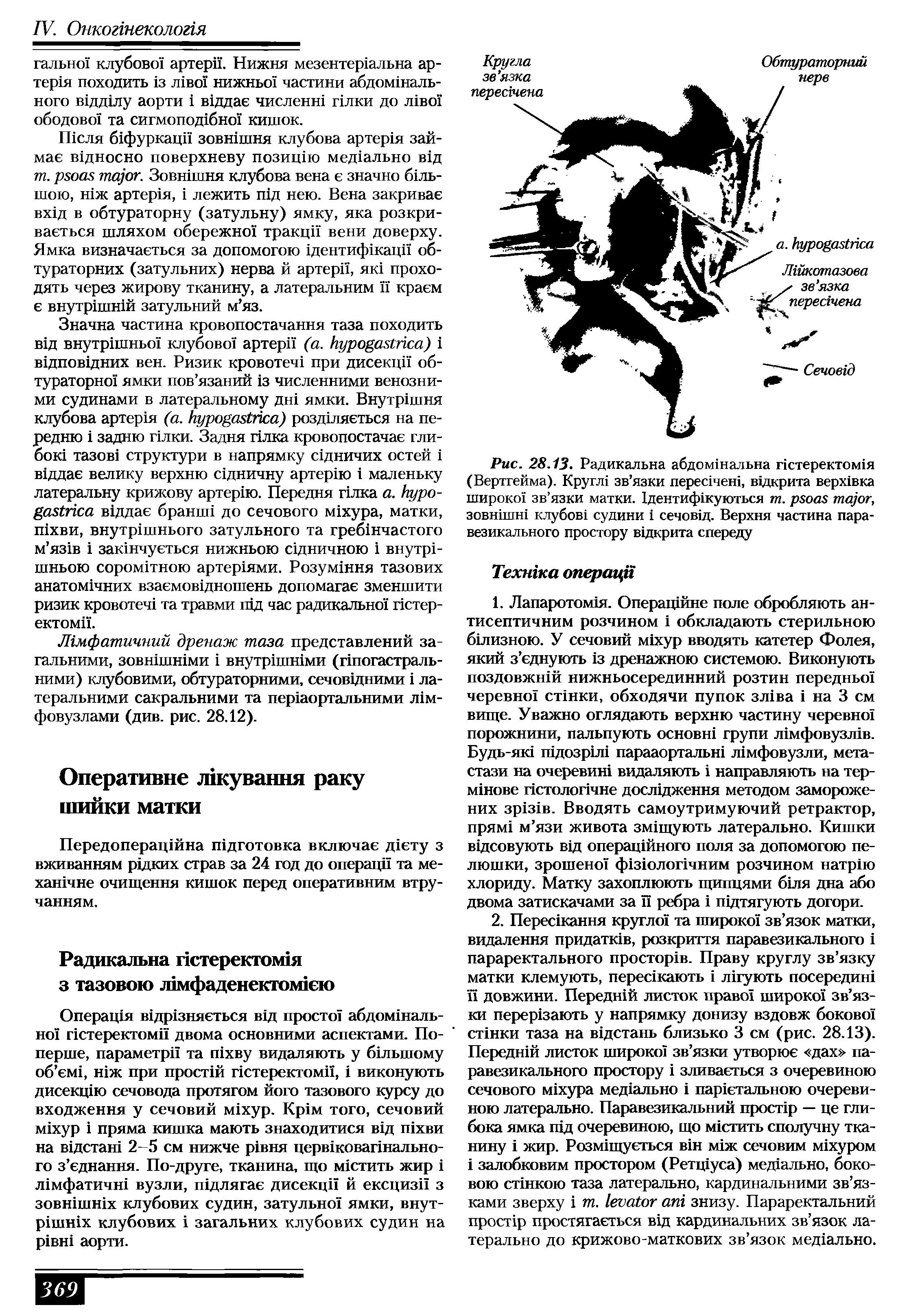 Рис. 28.13. Радикальна абдомшальна пстеректом1я (Вертгейма). K зв язки H , вщкрита B BK широко зв язки матки. 1дентиф1куються т. , зовшшш клубов судини сечовщ. Верхня частина пара-везикального простору вщкрита спереду...