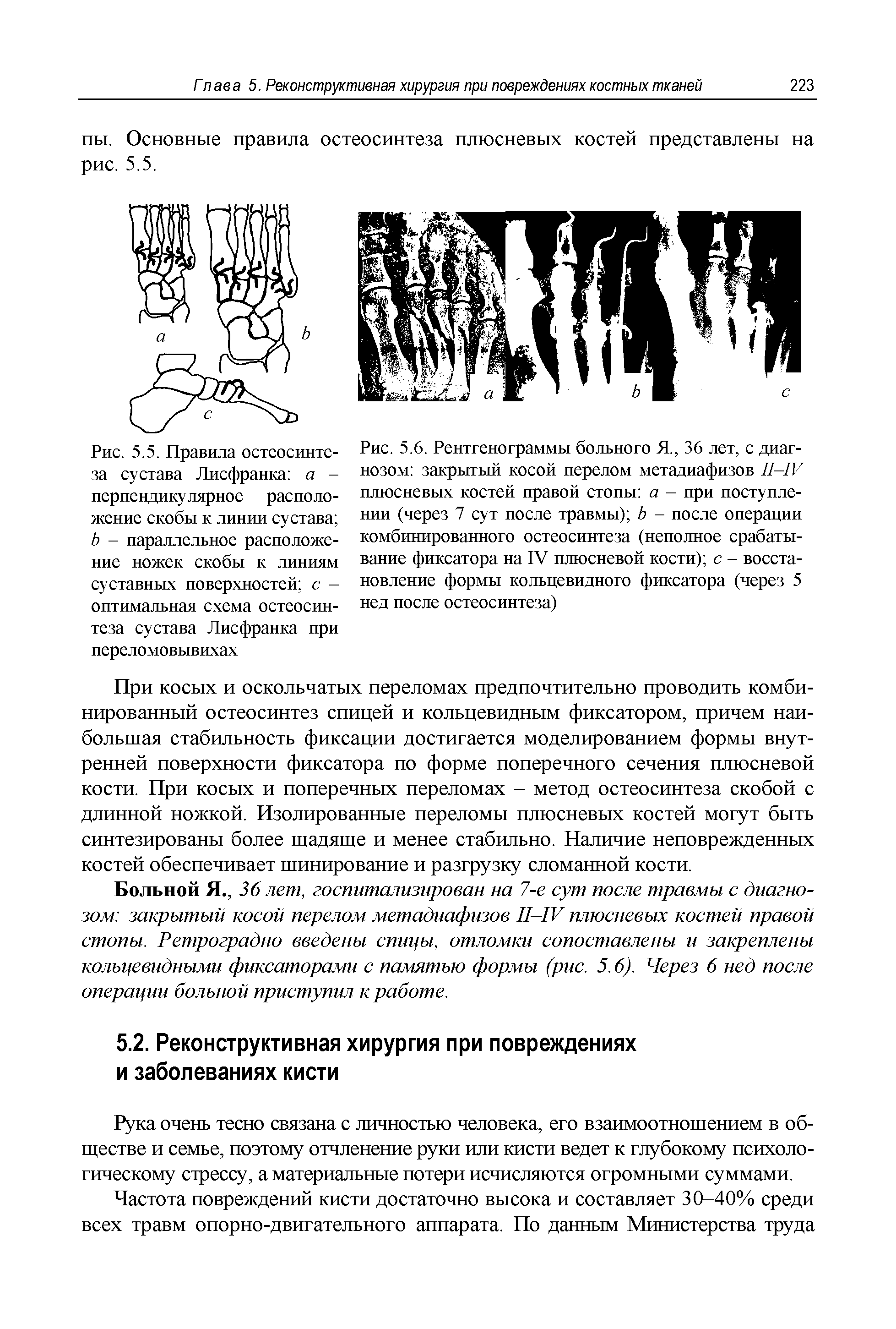 Рис. 5.6. Рентгенограммы больного Я., 36 лет, с диагнозом закрытый косой перелом метадиафизов П-ГР плюсневых костей правой стопы а - при поступлении (через 7 сут после травмы) Ь - после операции комбинированного остеосинтеза (неполное срабатывание фиксатора на IV плюсневой кости) с - восстановление формы кольцевидного фиксатора (через 5 нед после остеосинтеза)...