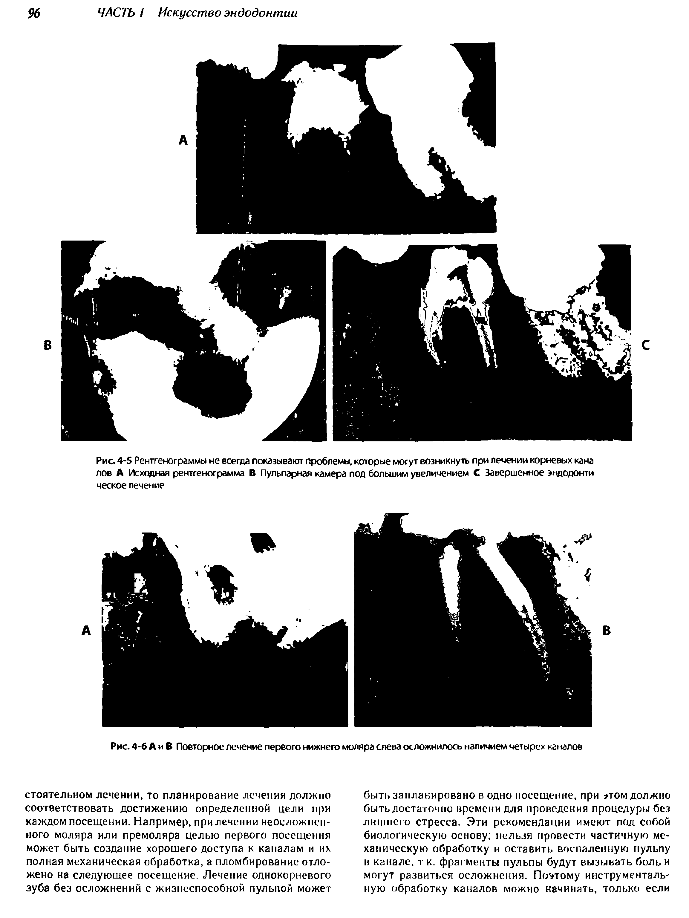 Рис. 4-5 Рентгенограммы не всегда показывают проблемы, которые могут возникнуть при лечении корневых кана лов А Исходная рентгенограмма В Пульпарная камера под большим увеличением С Завершенное эндодонти ческое лечение...