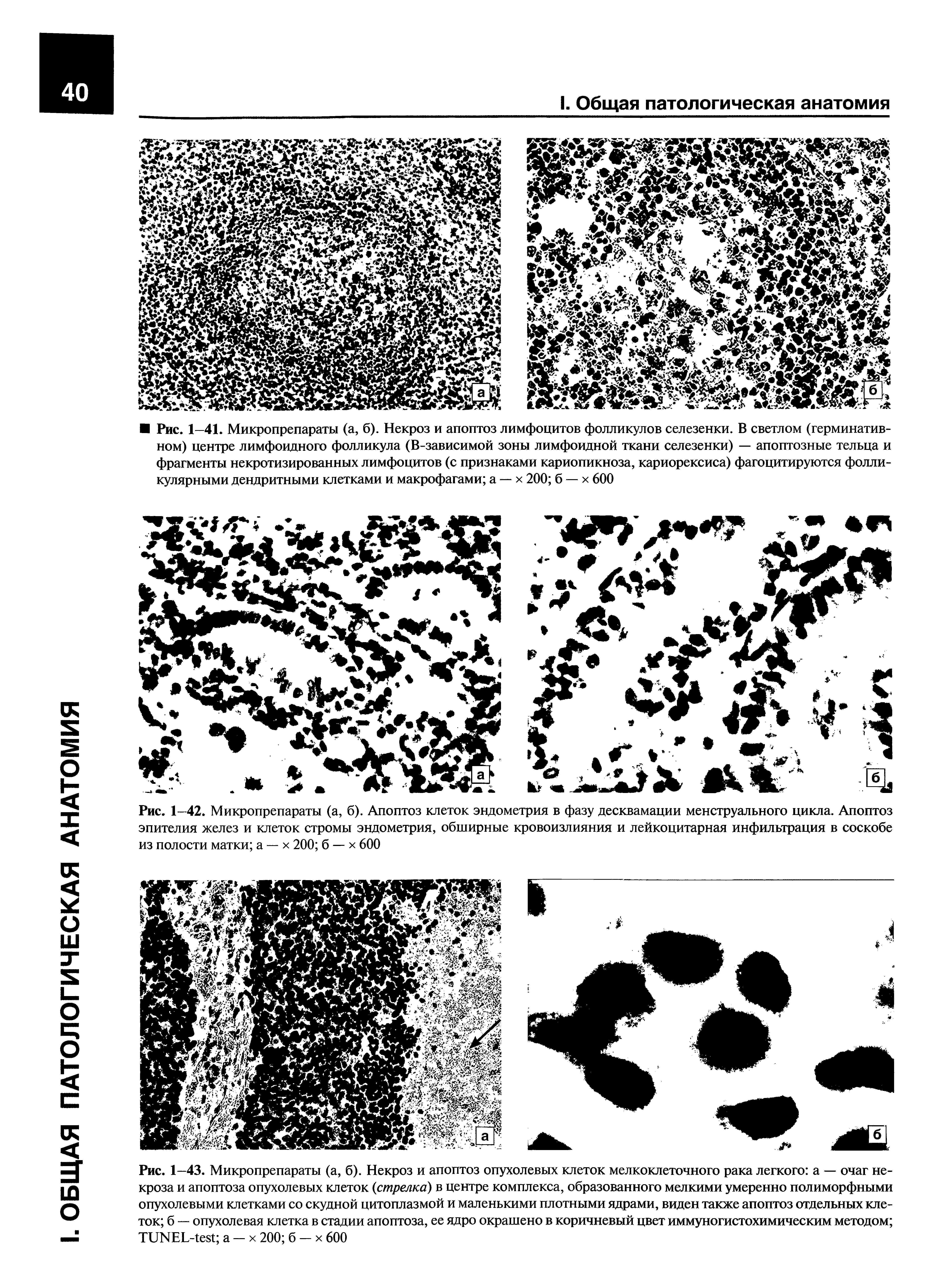 Рис. 1—42. Микропрепараты (а, б). Апоптоз клеток эндометрия в фазу десквамации менструального цикла. Апоптоз эпителия желез и клеток стромы эндометрия, обширные кровоизлияния и лейкоцитарная инфильтрация в соскобе из полости матки а — х 200 б — х 600...